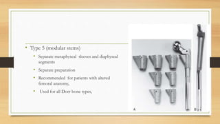 • Type 5 (modular stems)
• Separate metaphyseal sleeves and diaphyseal
segments
• Separate preparation
• Recommended for patients with altered
femoral anatomy,
• Used for all Dorr bone types,
 