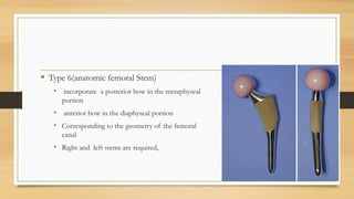  Type 6(anatomic femoral Stem)
• incorporate a posterior bow in the metaphyseal
portion
• anterior bow in the diaphyseal portion
• Corresponding to the geometry of the femoral
canal
• Right and left stems are required,
 