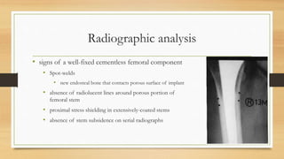 Radiographic analysis
• signs of a well-fixed cementless femoral component
• Spot-welds
• new endosteal bone that contacts porous surface of implant
• absence of radiolucent lines around porous portion of
femoral stem
• proximal stress shielding in extensively-coated stems
• absence of stem subsidence on serial radiographs
 