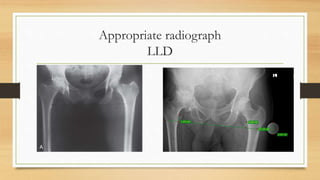 Appropriate radiograph
LLD
 