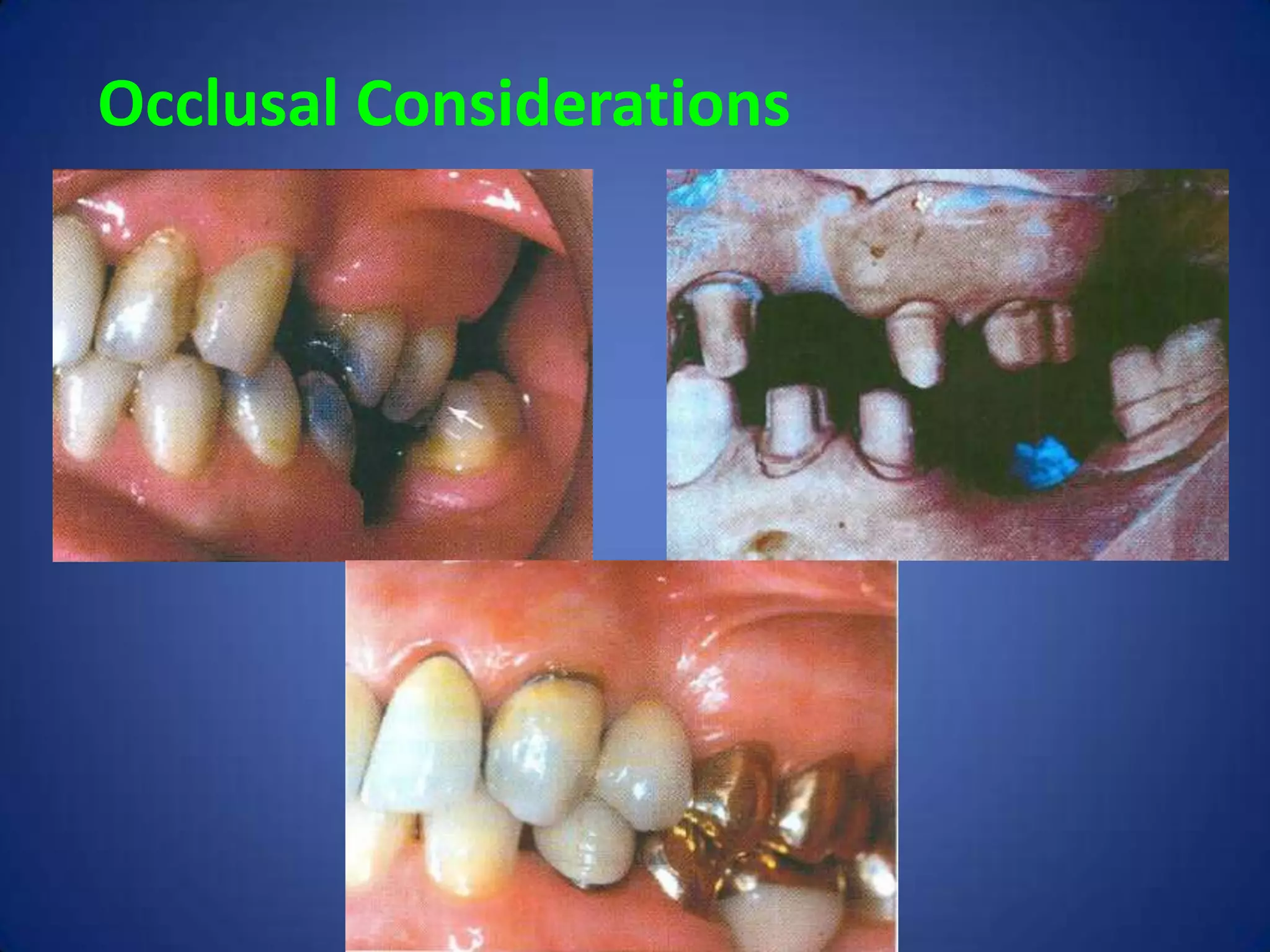 Occlusal Considerations

 