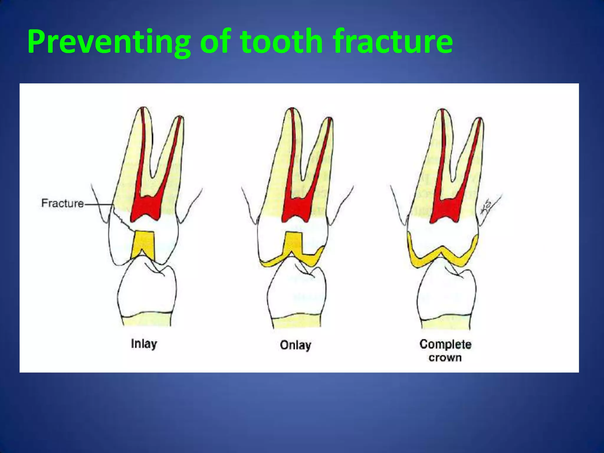 Preventing of tooth fracture

 