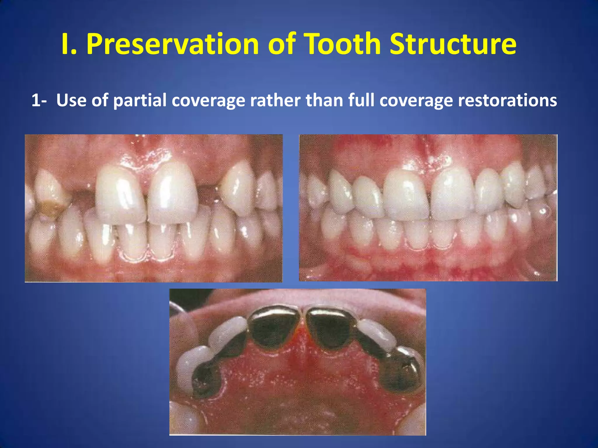 I. Preservation of Tooth Structure
1- Use of partial coverage rather than full coverage restorations

 