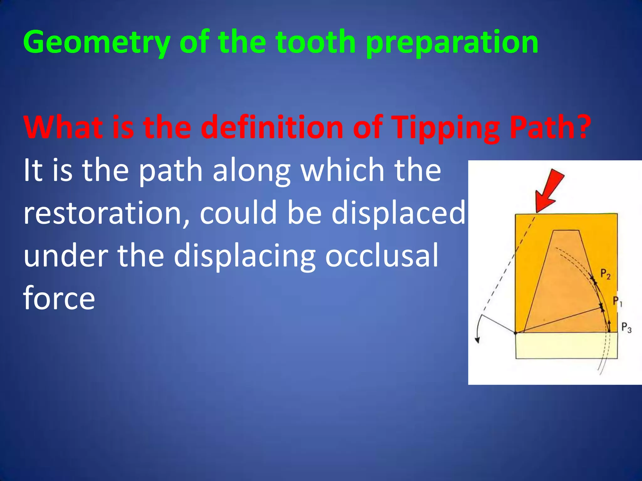Geometry of the tooth preparation
What is the definition of Tipping Path?
It is the path along which the
restoration, could be displaced
under the displacing occlusal
force

 
