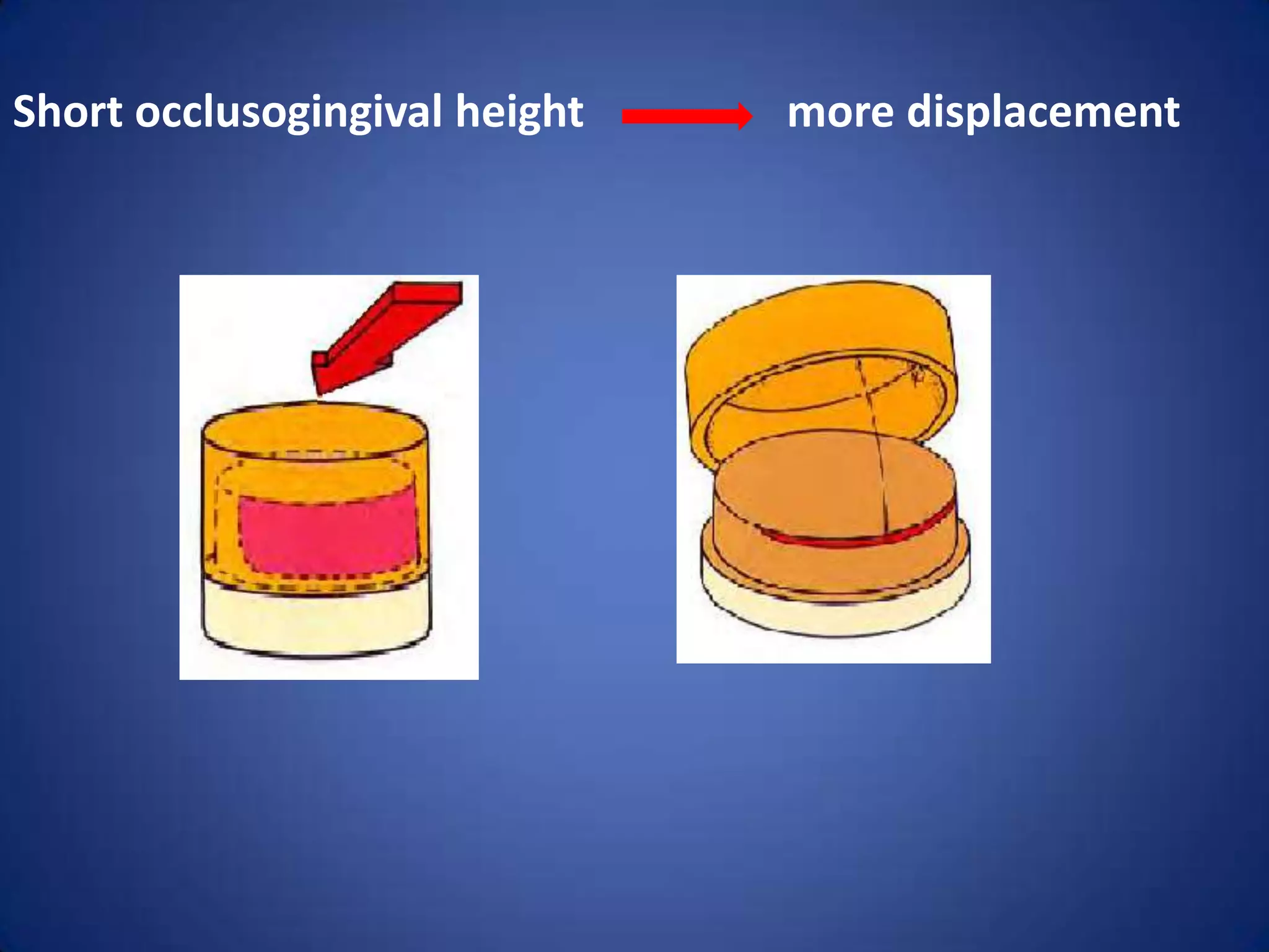 Short occlusogingival height

more displacement

 