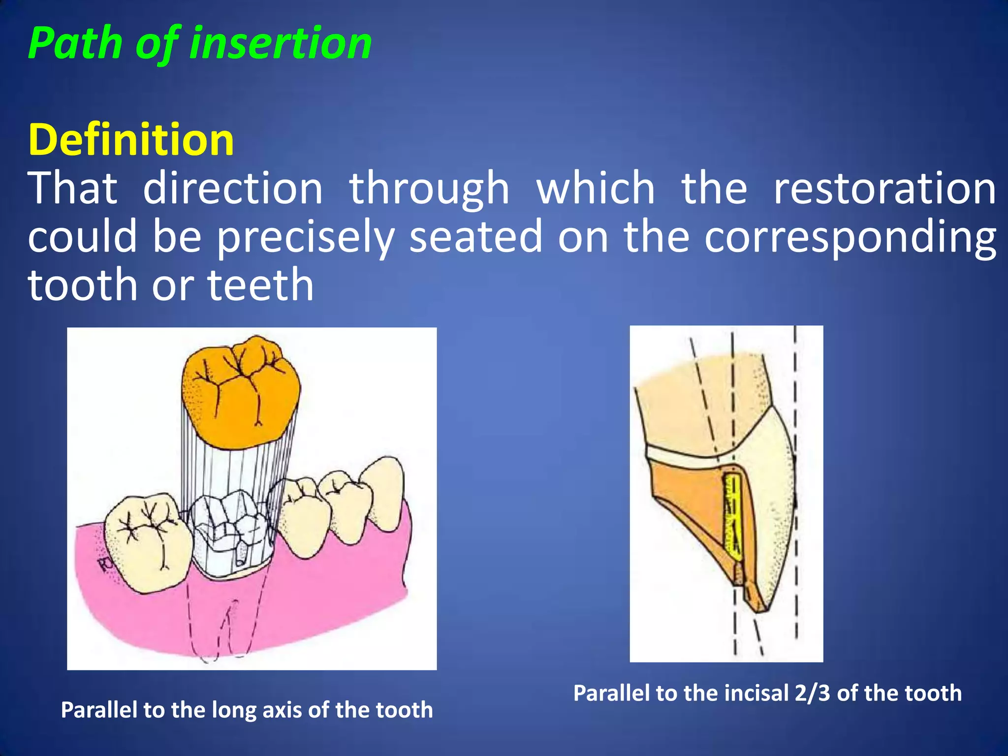 Path of insertion
Definition
That direction through which the restoration
could be precisely seated on the corresponding
tooth or teeth

Parallel to the long axis of the tooth

Parallel to the incisal 2/3 of the tooth

 