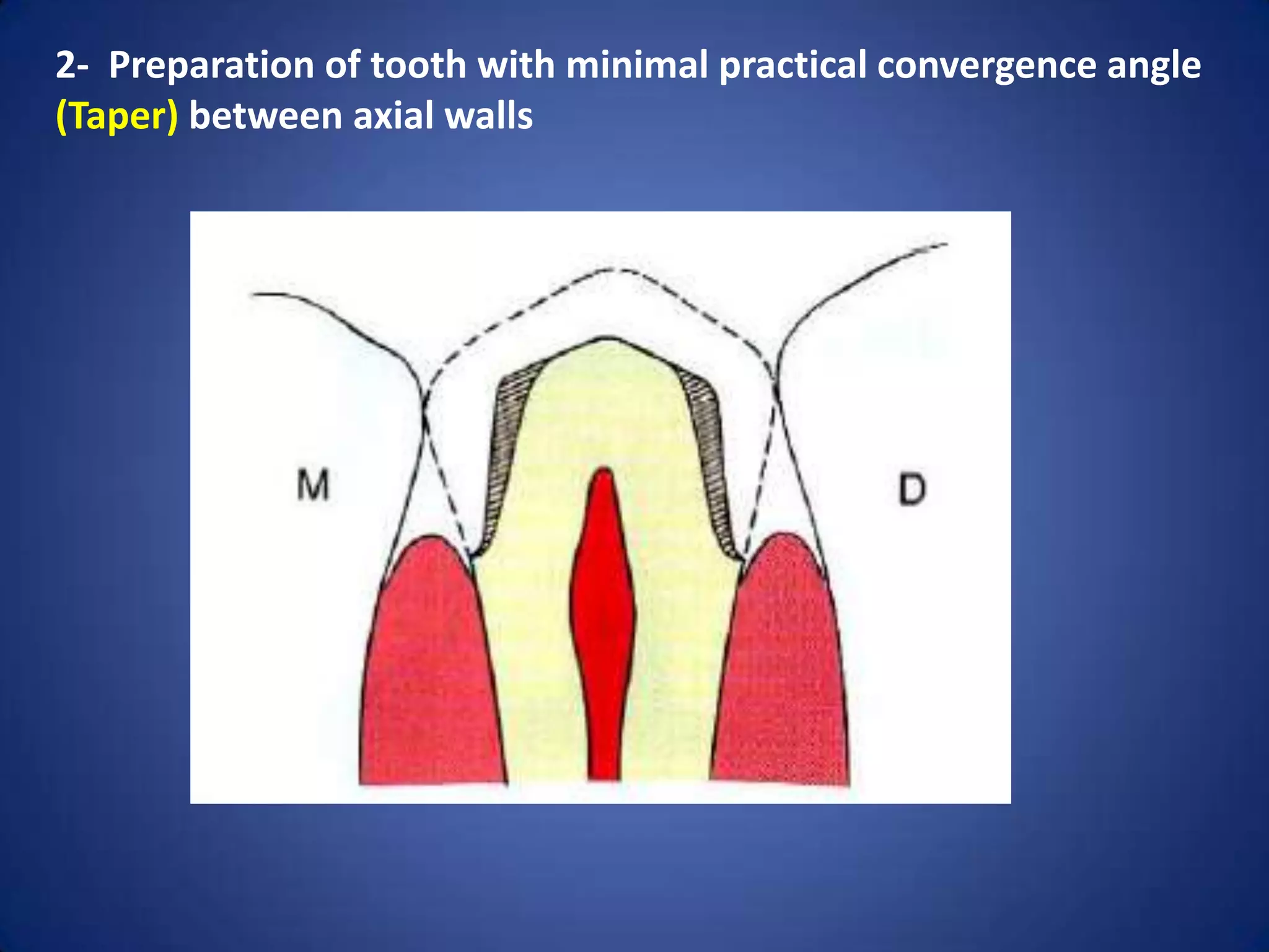 2- Preparation of tooth with minimal practical convergence angle
(Taper) between axial walls

 