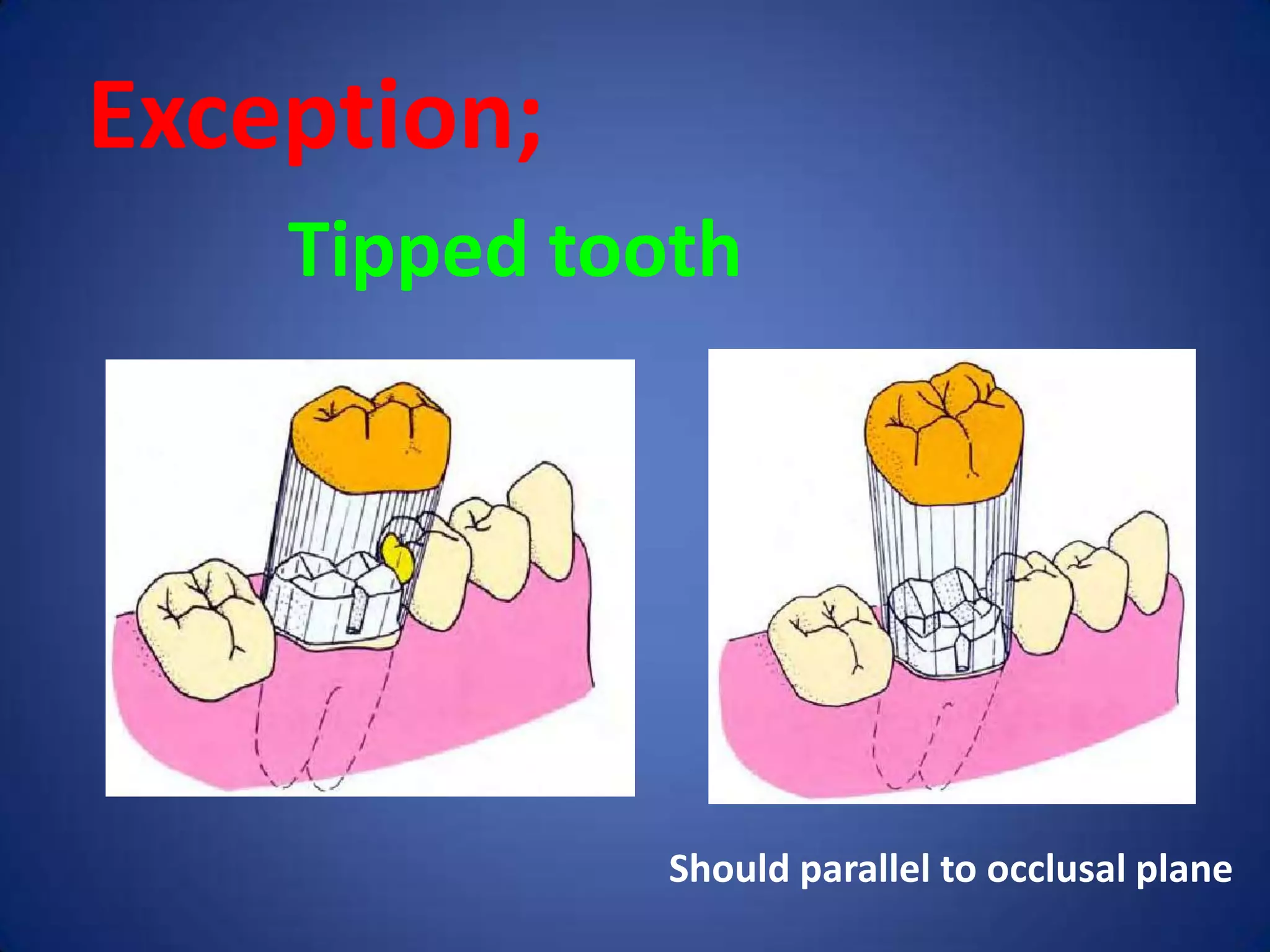 Exception;
Tipped tooth

Should parallel to occlusal plane

 