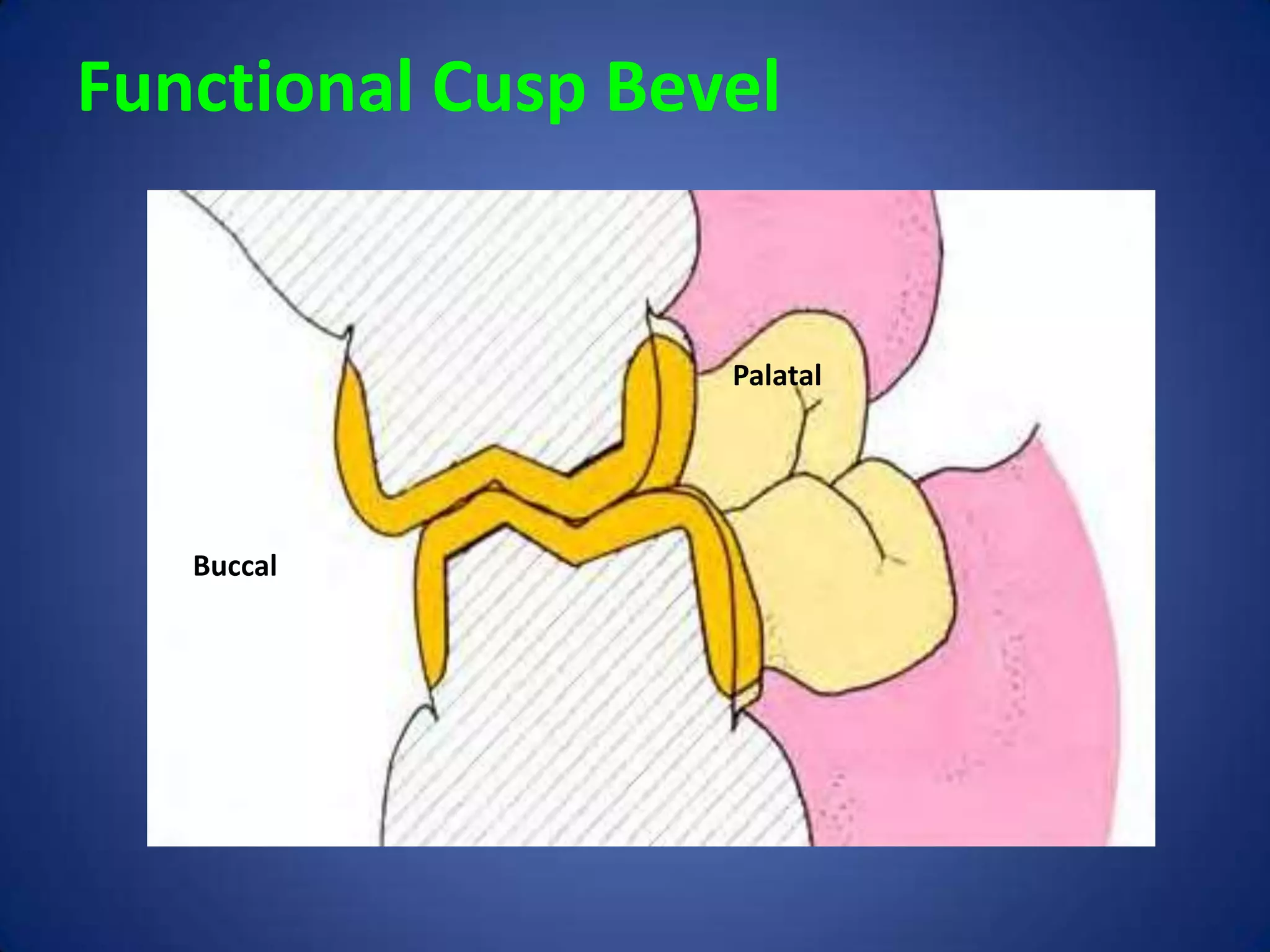 Functional Cusp Bevel

Palatal

Buccal

 