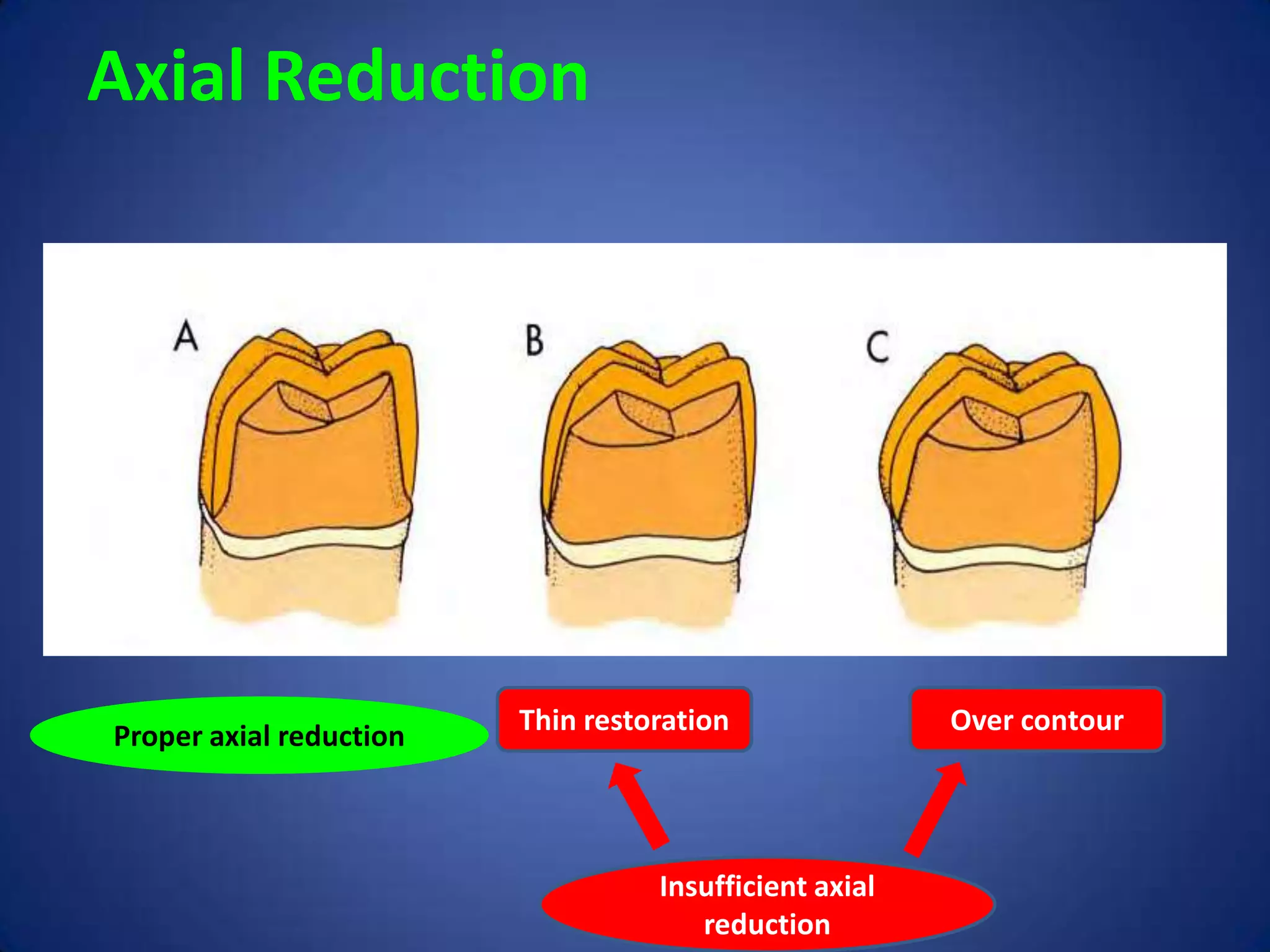 Axial Reduction

Proper axial reduction

Thin restoration

Insufficient axial
reduction

Over contour

 