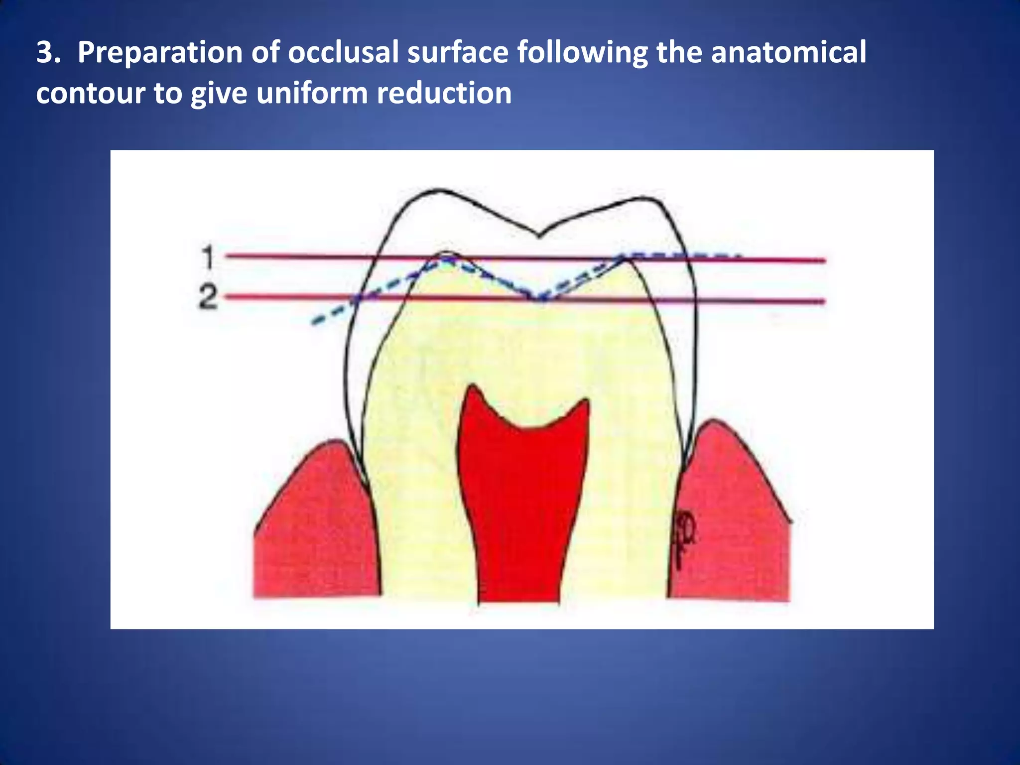 3. Preparation of occlusal surface following the anatomical
contour to give uniform reduction

 