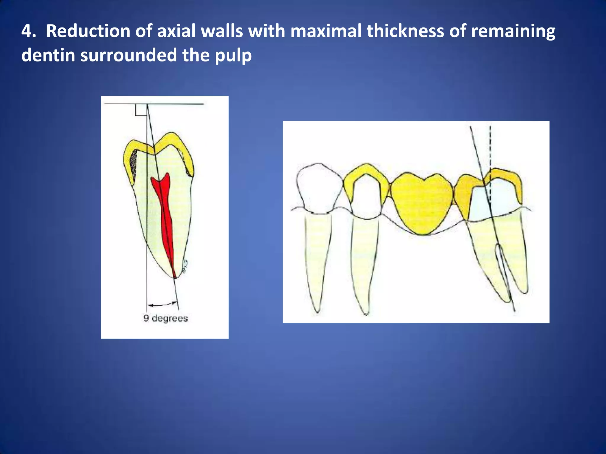 4. Reduction of axial walls with maximal thickness of remaining
dentin surrounded the pulp

 