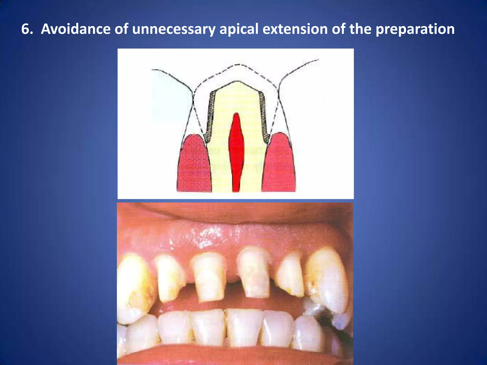 6. Avoidance of unnecessary apical extension of the preparation

 