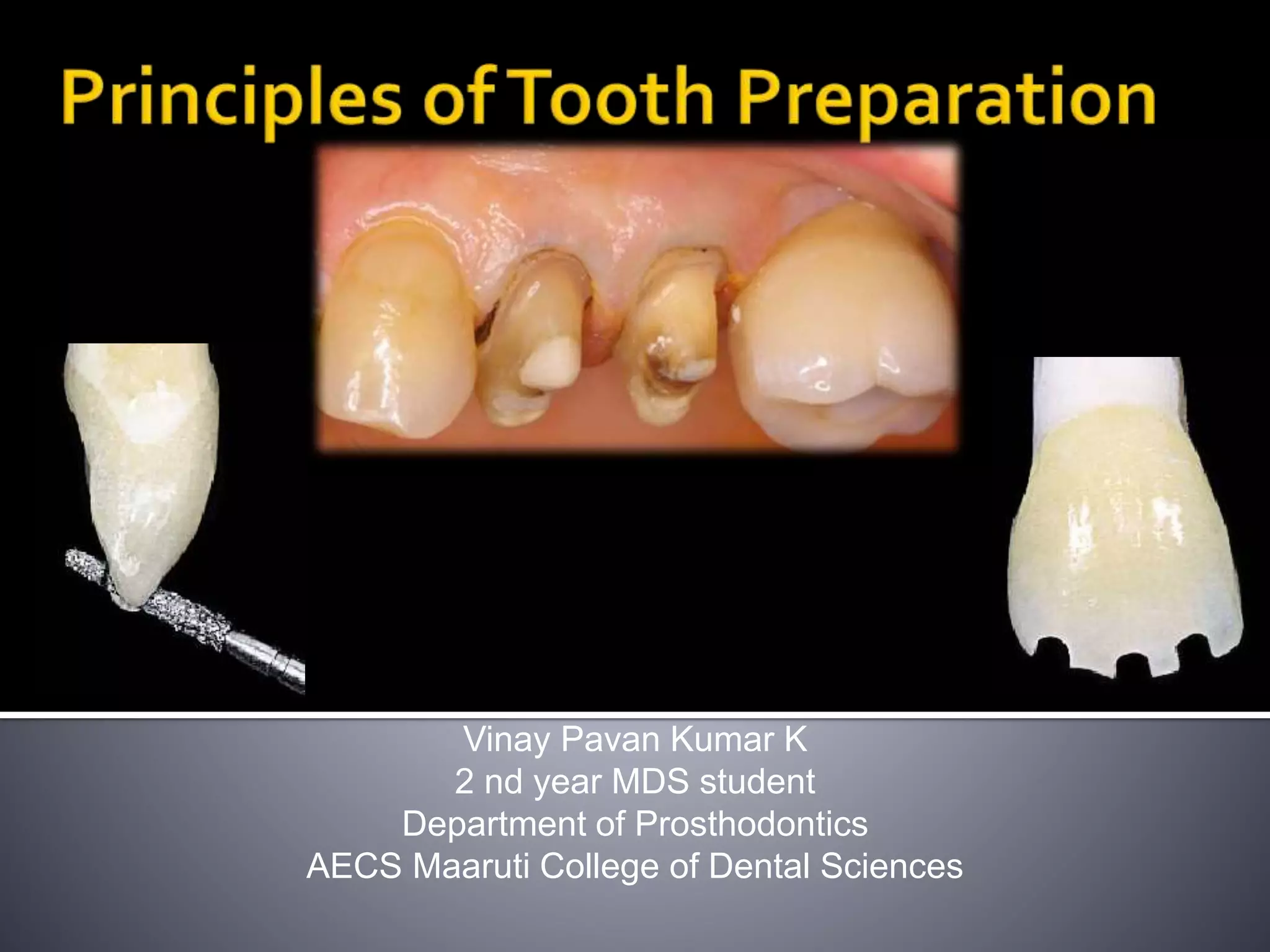 Principles of tooth preparation in Fixed Partial Dentures | PPTX