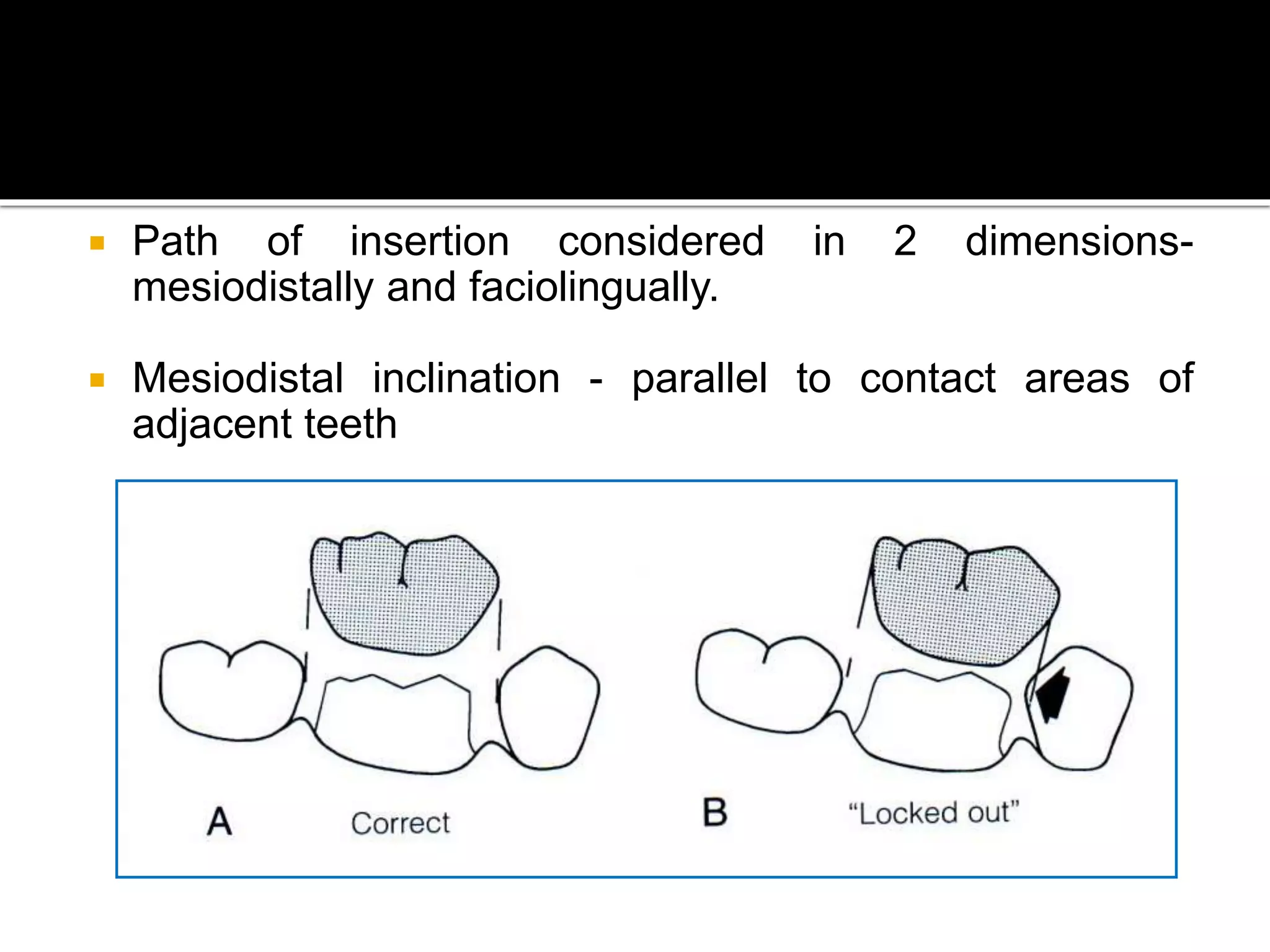 Principles of tooth preparation in Fixed Partial Dentures | PPT