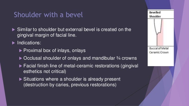 Ppt Porcelain Inlay And Onlay Powerpoint Presentation Free Download Id 6694296