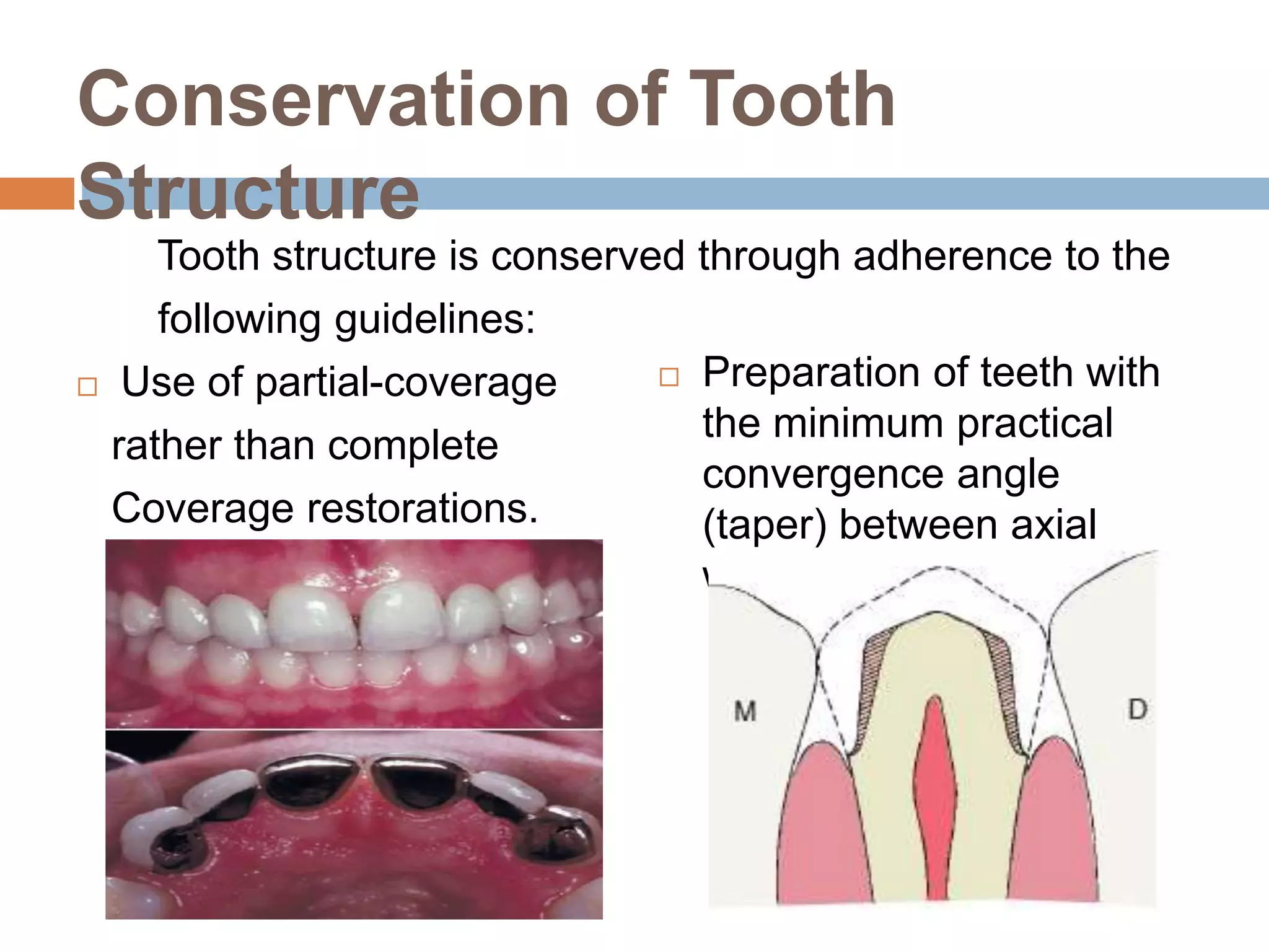Conservation of Tooth
Structure
Tooth structure is conserved through adherence to the
following guidelines:
 Use of partial-coverage
rather than complete
Coverage restorations.
 Preparation of teeth with
the minimum practical
convergence angle
(taper) between axial
walls
 