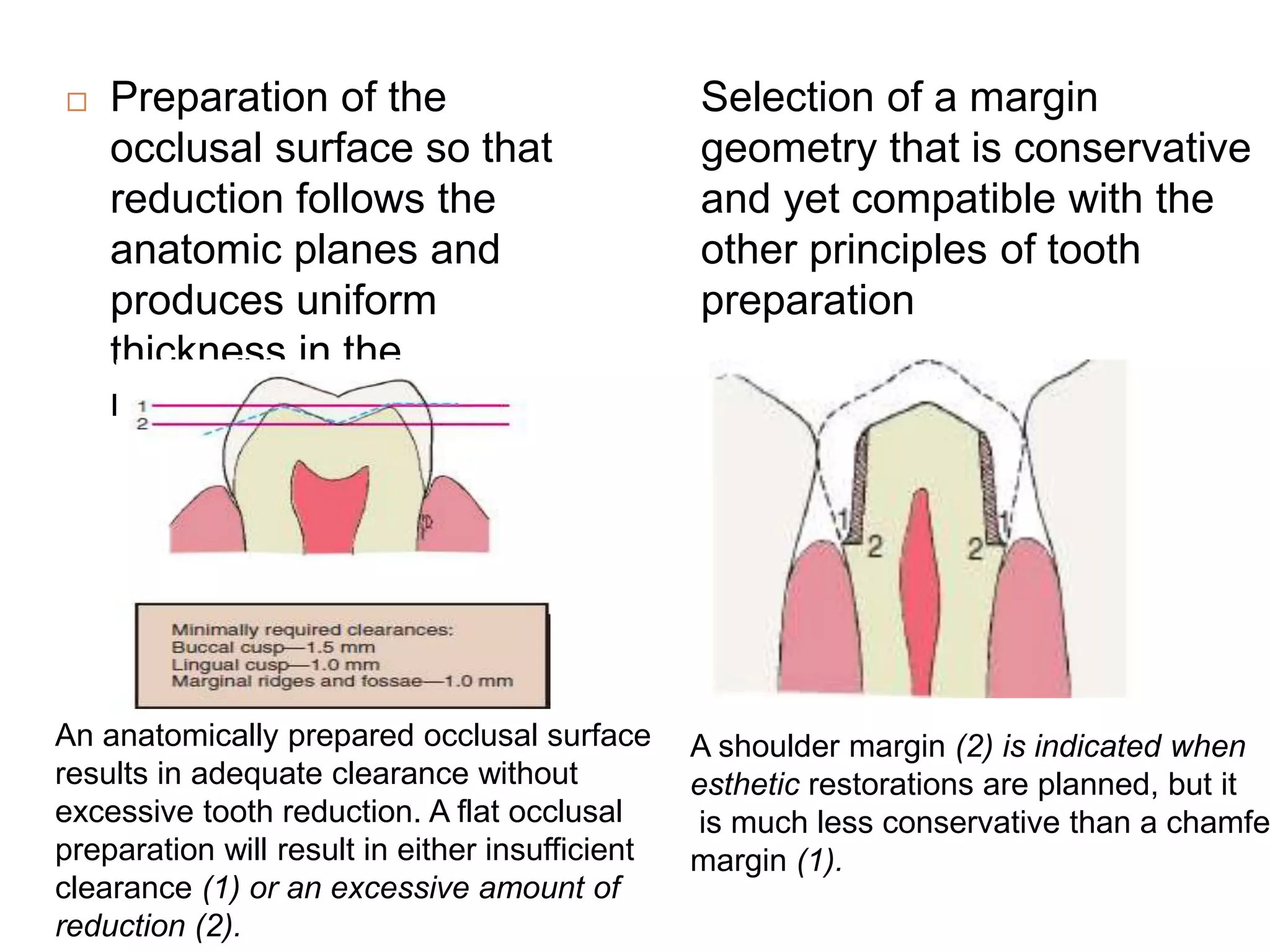 Preparation of the
occlusal surface so that
reduction follows the
anatomic planes and
produces uniform
thickness in the
restoration.
A shoulder margin (2) is indicated when
esthetic restorations are planned, but it
is much less conservative than a chamfe
margin (1).
An anatomically prepared occlusal surface
results in adequate clearance without
excessive tooth reduction. A flat occlusal
preparation will result in either insufficient
clearance (1) or an excessive amount of
reduction (2).
Selection of a margin
geometry that is conservative
and yet compatible with the
other principles of tooth
preparation
 