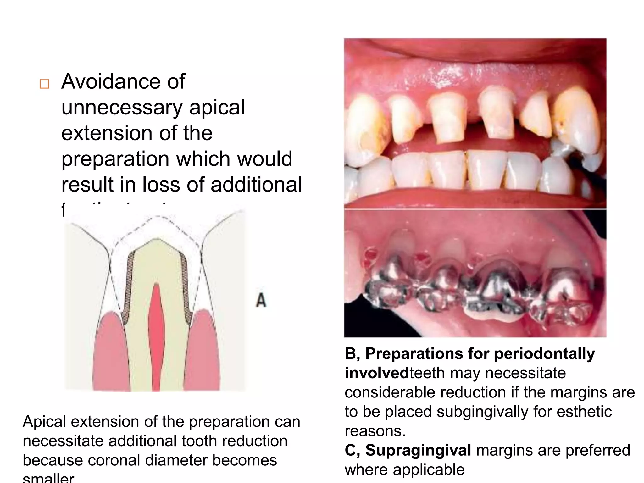  Avoidance of
unnecessary apical
extension of the
preparation which would
result in loss of additional
tooth structure
Apical extension of the preparation can
necessitate additional tooth reduction
because coronal diameter becomes
B, Preparations for periodontally
involvedteeth may necessitate
considerable reduction if the margins are
to be placed subgingivally for esthetic
reasons.
C, Supragingival margins are preferred
where applicable
 