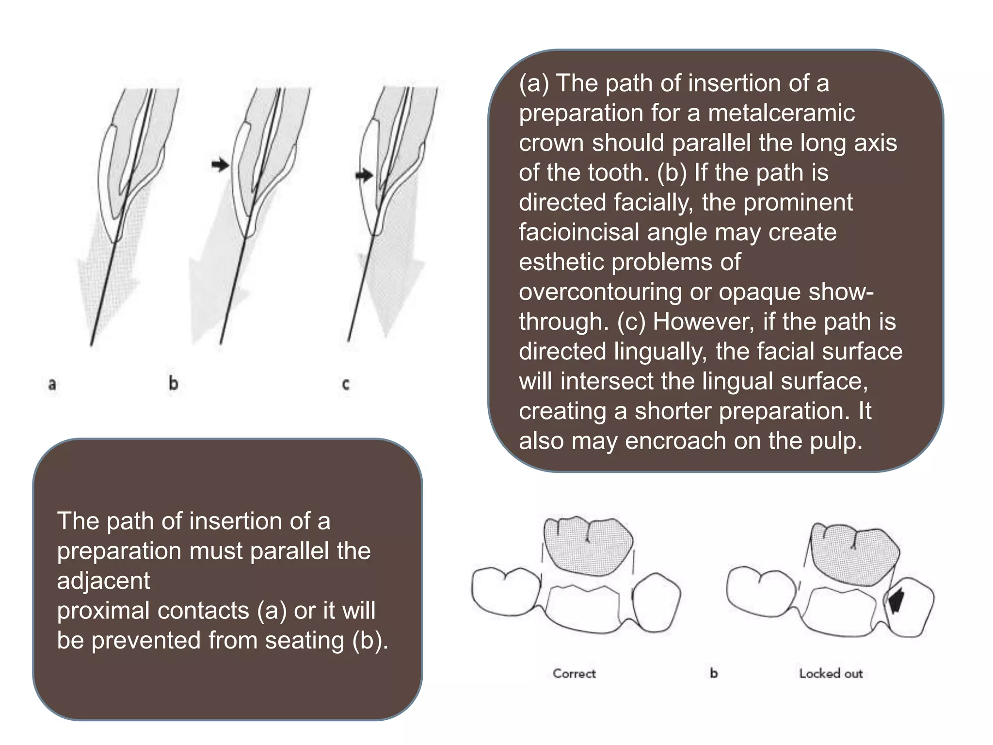 The path of insertion of a
preparation must parallel the
adjacent
proximal contacts (a) or it will
be prevented from seating (b).
(a) The path of insertion of a
preparation for a metalceramic
crown should parallel the long axis
of the tooth. (b) If the path is
directed facially, the prominent
facioincisal angle may create
esthetic problems of
overcontouring or opaque show-
through. (c) However, if the path is
directed lingually, the facial surface
will intersect the lingual surface,
creating a shorter preparation. It
also may encroach on the pulp.
 