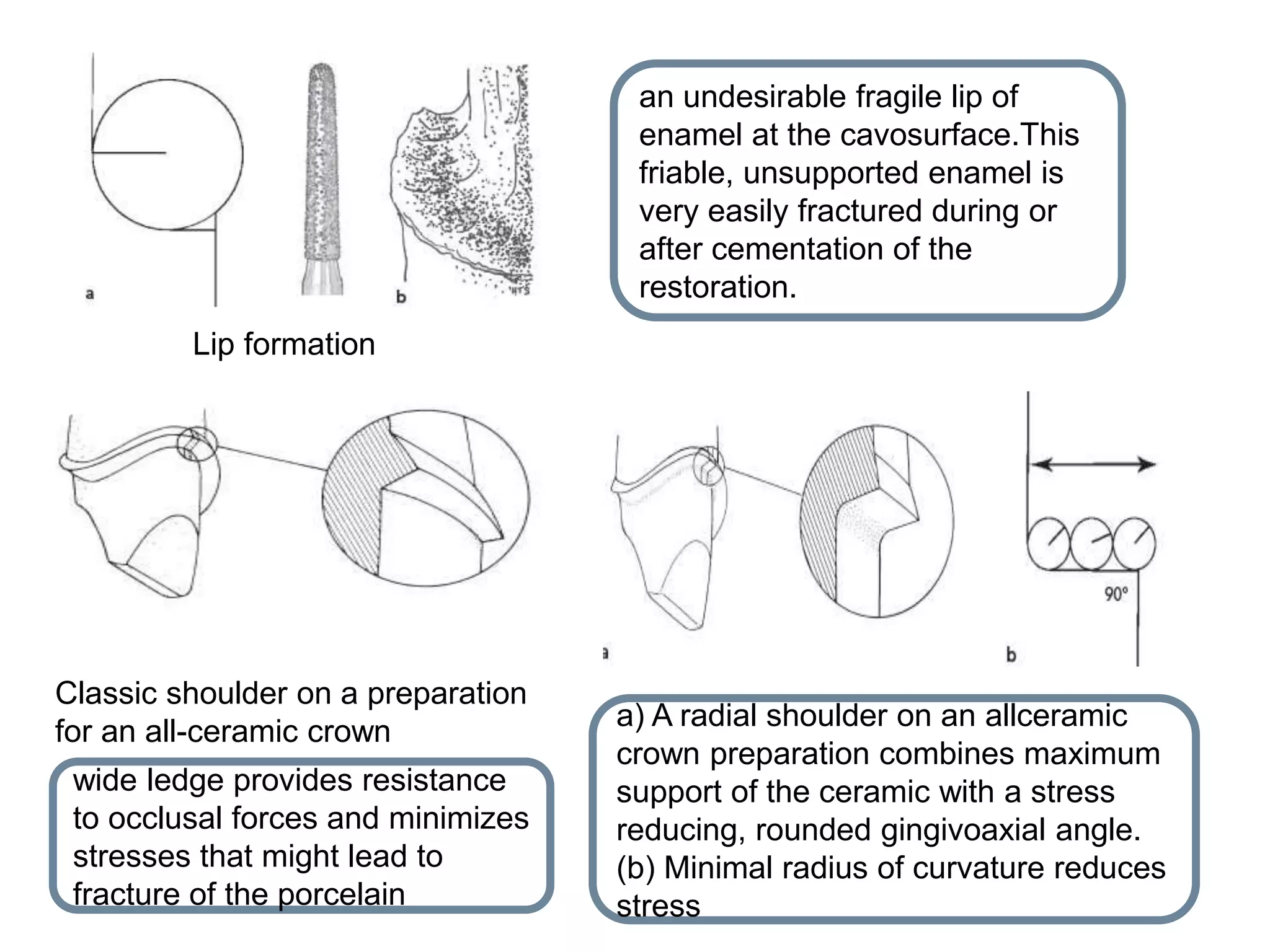 Lip formation
an undesirable fragile lip of
enamel at the cavosurface.This
friable, unsupported enamel is
very easily fractured during or
after cementation of the
restoration.
Classic shoulder on a preparation
for an all-ceramic crown
wide ledge provides resistance
to occlusal forces and minimizes
stresses that might lead to
fracture of the porcelain
a) A radial shoulder on an allceramic
crown preparation combines maximum
support of the ceramic with a stress
reducing, rounded gingivoaxial angle.
(b) Minimal radius of curvature reduces
stress
 