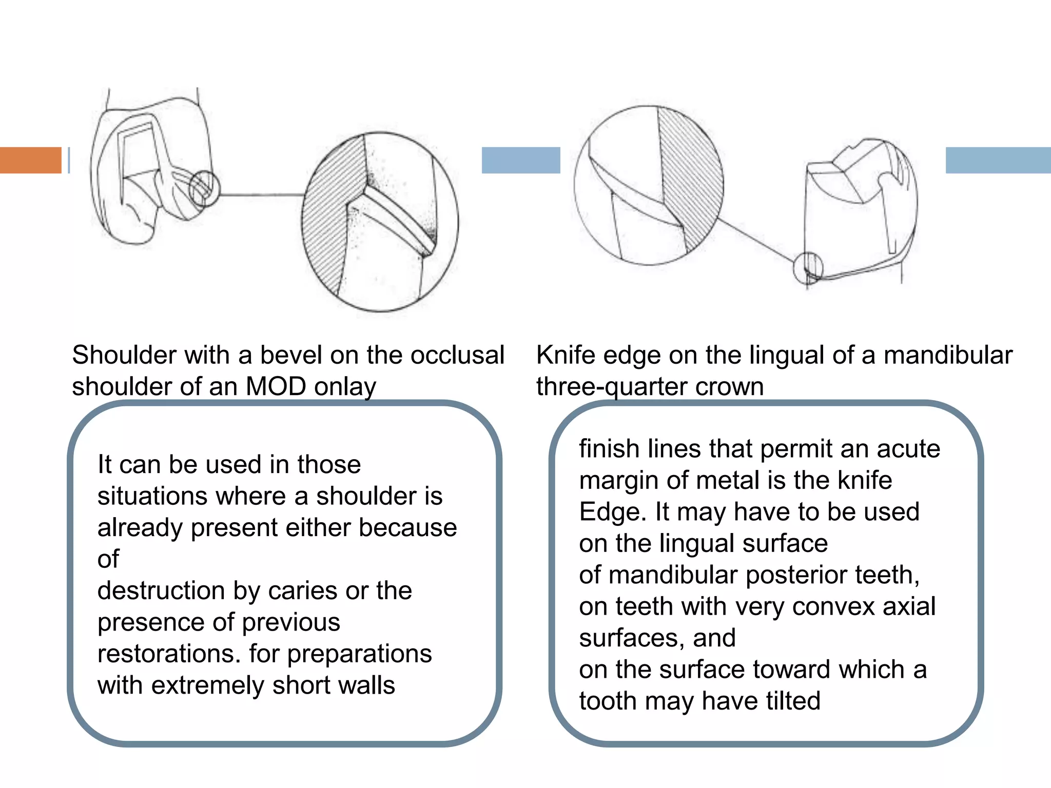 It can be used in those
situations where a shoulder is
already present either because
of
destruction by caries or the
presence of previous
restorations. for preparations
with extremely short walls
finish lines that permit an acute
margin of metal is the knife
Edge. It may have to be used
on the lingual surface
of mandibular posterior teeth,
on teeth with very convex axial
surfaces, and
on the surface toward which a
tooth may have tilted
Shoulder with a bevel on the occlusal
shoulder of an MOD onlay
Knife edge on the lingual of a mandibular
three-quarter crown
 