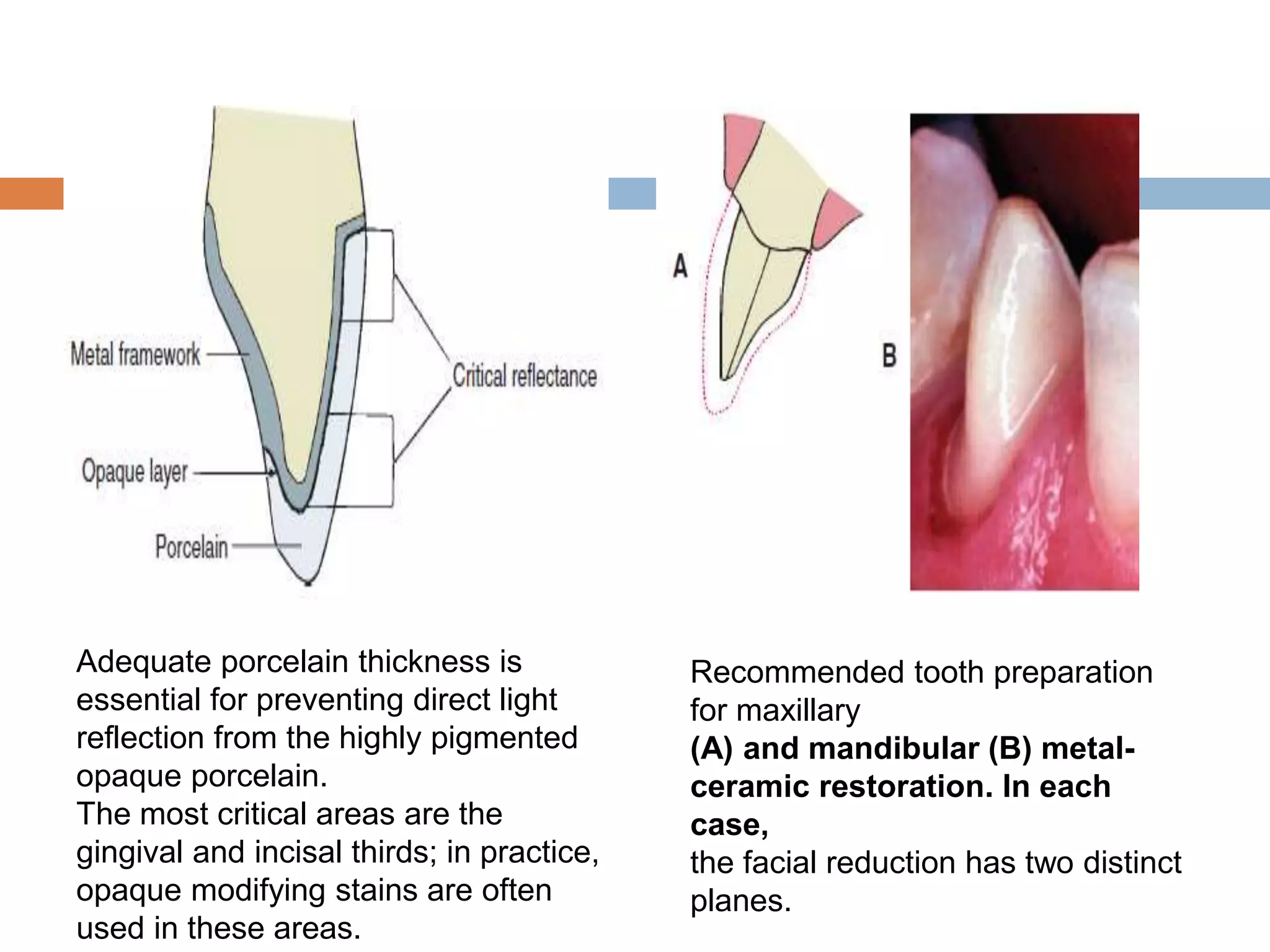 Recommended tooth preparation
for maxillary
(A) and mandibular (B) metal-
ceramic restoration. In each
case,
the facial reduction has two distinct
planes.
Adequate porcelain thickness is
essential for preventing direct light
reflection from the highly pigmented
opaque porcelain.
The most critical areas are the
gingival and incisal thirds; in practice,
opaque modifying stains are often
used in these areas.
 