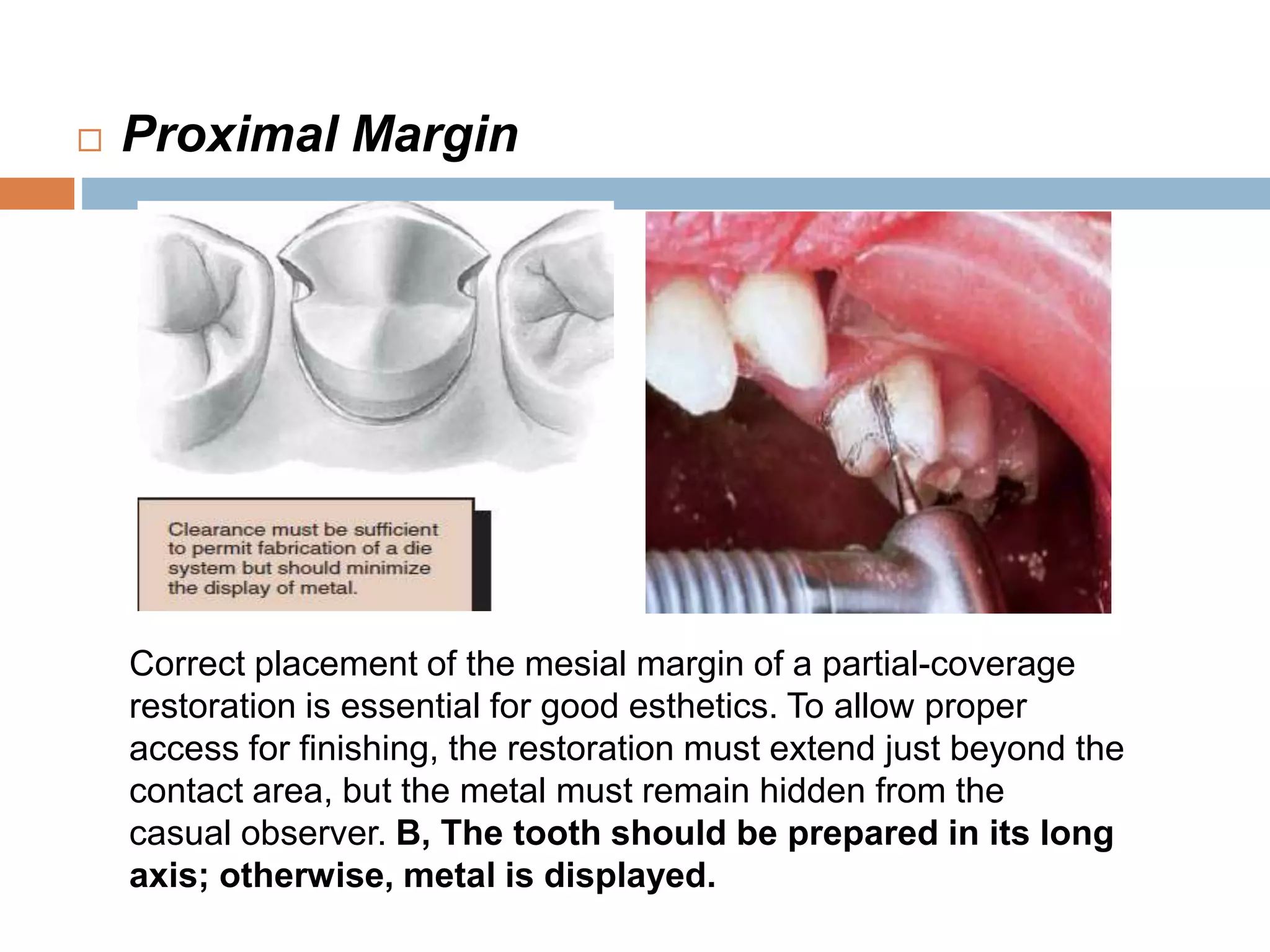  Proximal Margin
Correct placement of the mesial margin of a partial-coverage
restoration is essential for good esthetics. To allow proper
access for finishing, the restoration must extend just beyond the
contact area, but the metal must remain hidden from the
casual observer. B, The tooth should be prepared in its long
axis; otherwise, metal is displayed.
 