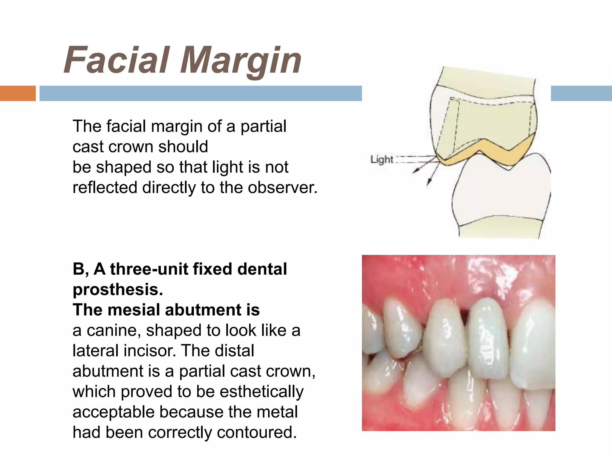 Facial Margin
The facial margin of a partial
cast crown should
be shaped so that light is not
reflected directly to the observer.
B, A three-unit fixed dental
prosthesis.
The mesial abutment is
a canine, shaped to look like a
lateral incisor. The distal
abutment is a partial cast crown,
which proved to be esthetically
acceptable because the metal
had been correctly contoured.
 