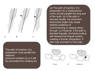 Principles of tooth preparation | PPTX