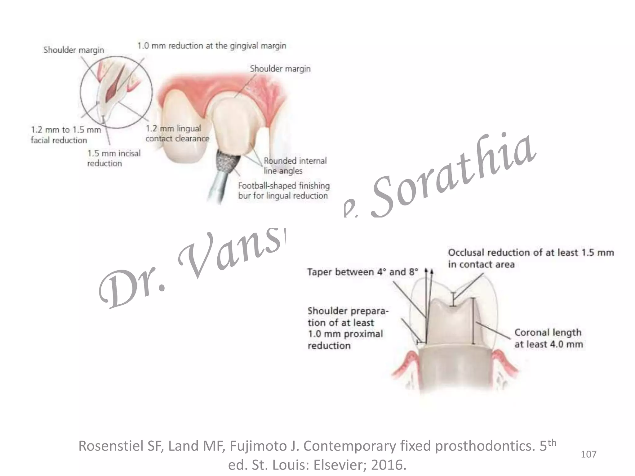 Rosenstiel SF, Land MF, Fujimoto J. Contemporary fixed prosthodontics. 5th
ed. St. Louis: Elsevier; 2016.
107
 
