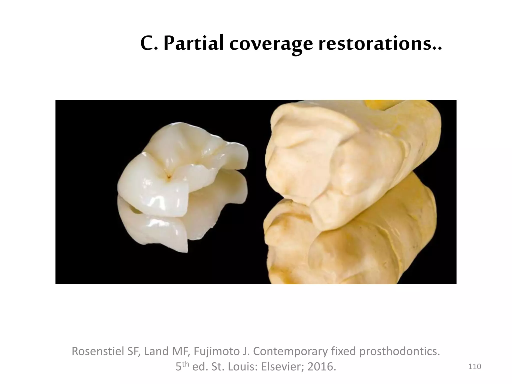 C. Partial coveragerestorations..
110
Rosenstiel SF, Land MF, Fujimoto J. Contemporary fixed prosthodontics.
5th ed. St. Louis: Elsevier; 2016.
 