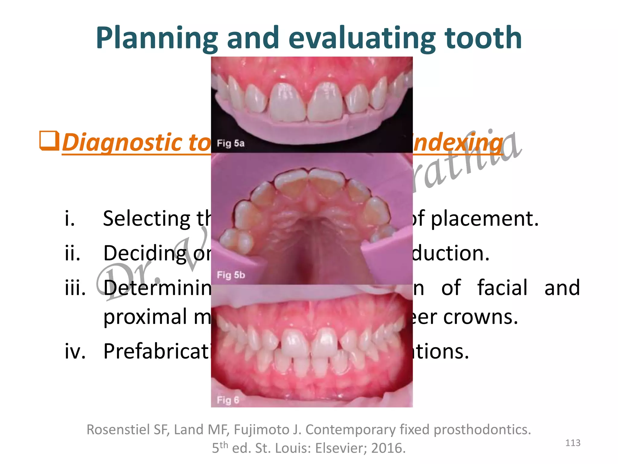 Planning and evaluating tooth
preparations
Rosenstiel SF, Land MF, Fujimoto J. Contemporary fixed prosthodontics.
5th ed. St. Louis: Elsevier; 2016. 113
Diagnostic tooth preparation, Indexing
i. Selecting the appropriate path of placement.
ii. Deciding on amount of tooth reduction.
iii. Determining the best location of facial and
proximal margins of partial veneer crowns.
iv. Prefabrication of interim restorations.
 