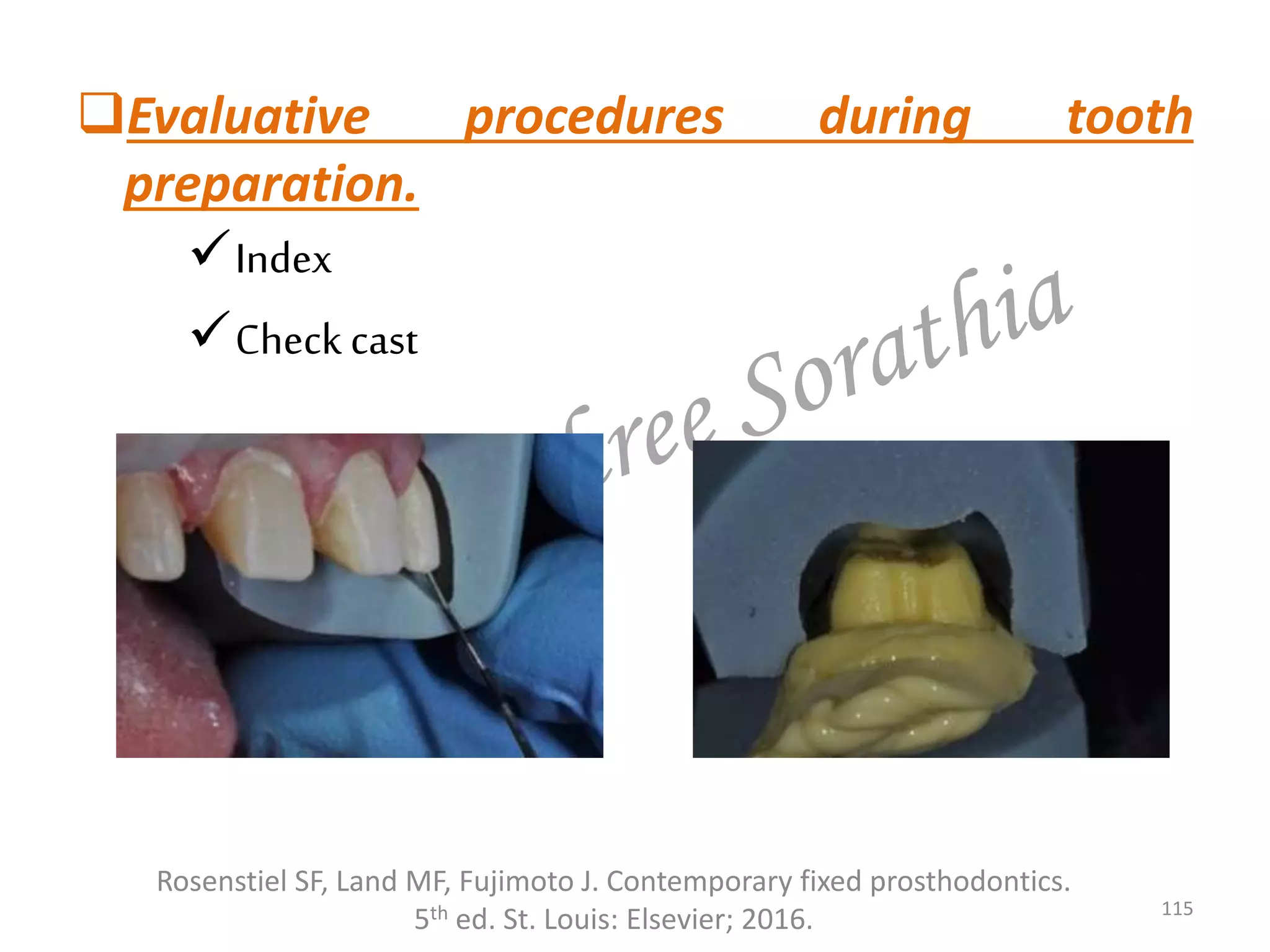 Evaluative procedures during tooth
preparation.
Index
Check cast
115
Rosenstiel SF, Land MF, Fujimoto J. Contemporary fixed prosthodontics.
5th ed. St. Louis: Elsevier; 2016.
 