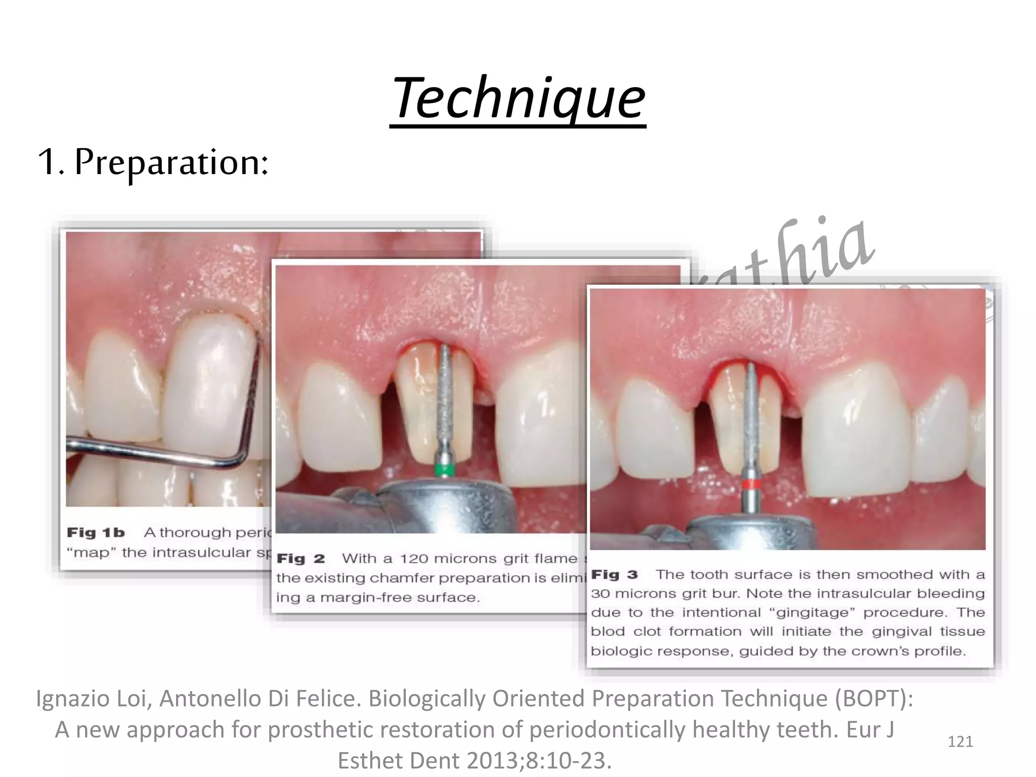 Technique
1. Preparation:
Ignazio Loi, Antonello Di Felice. Biologically Oriented Preparation Technique (BOPT):
A new approach for prosthetic restoration of periodontically healthy teeth. Eur J
Esthet Dent 2013;8:10-23.
121
 