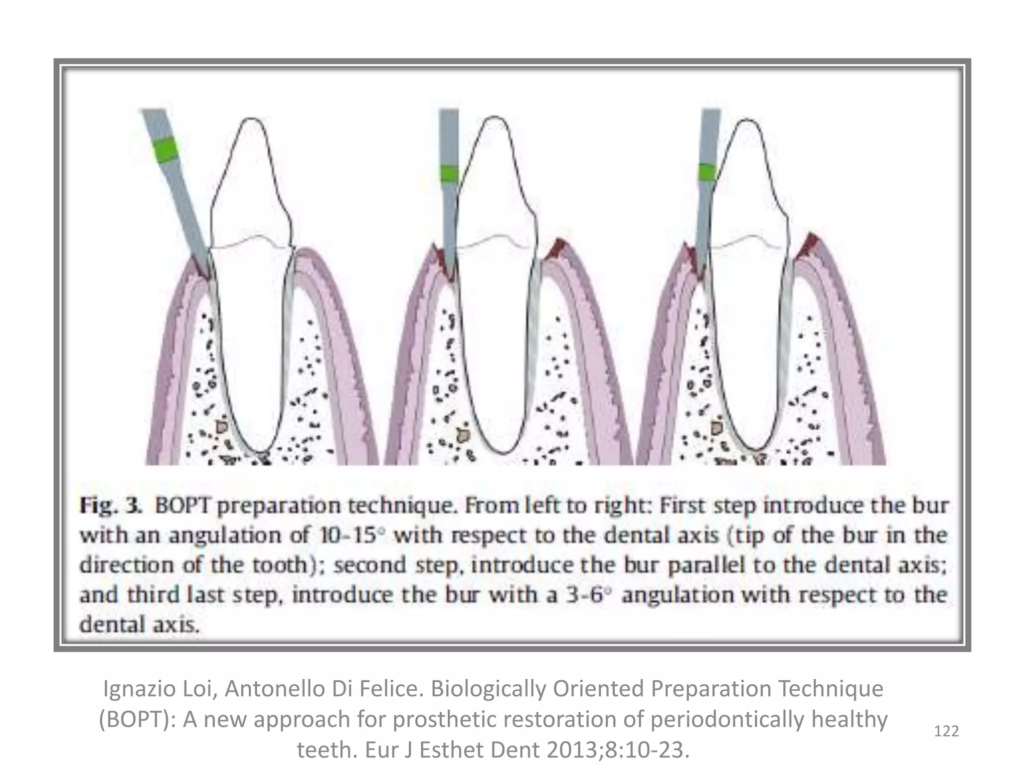 122
Ignazio Loi, Antonello Di Felice. Biologically Oriented Preparation Technique
(BOPT): A new approach for prosthetic restoration of periodontically healthy
teeth. Eur J Esthet Dent 2013;8:10-23.
 