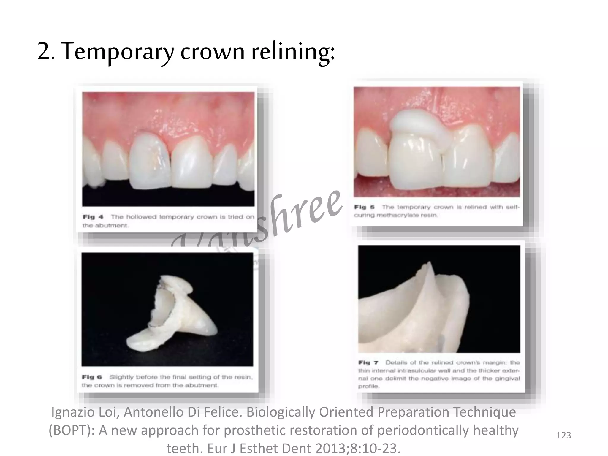 123
2. Temporary crown relining:
Ignazio Loi, Antonello Di Felice. Biologically Oriented Preparation Technique
(BOPT): A new approach for prosthetic restoration of periodontically healthy
teeth. Eur J Esthet Dent 2013;8:10-23.
 