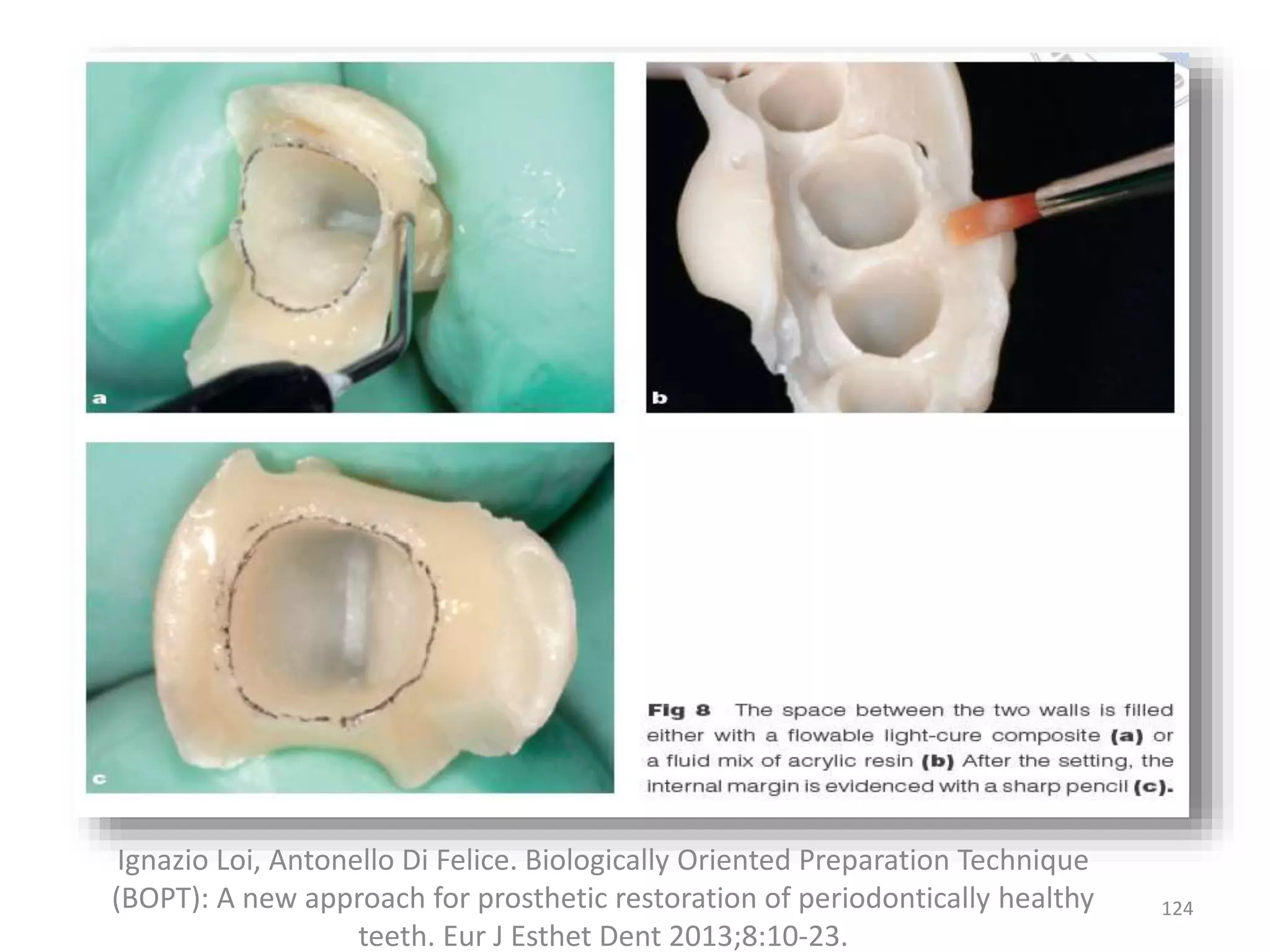 124
Ignazio Loi, Antonello Di Felice. Biologically Oriented Preparation Technique
(BOPT): A new approach for prosthetic restoration of periodontically healthy
teeth. Eur J Esthet Dent 2013;8:10-23.
 