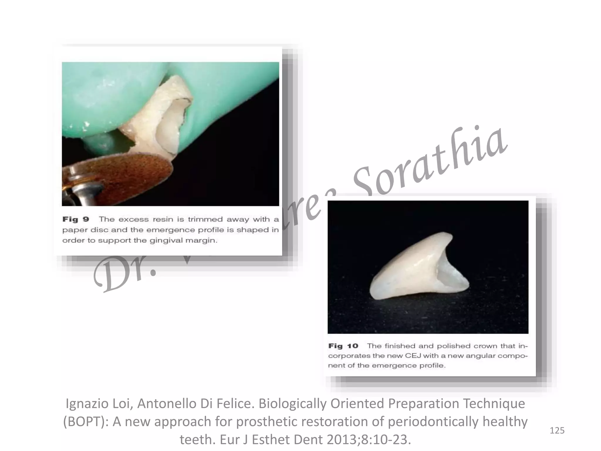 125
Ignazio Loi, Antonello Di Felice. Biologically Oriented Preparation Technique
(BOPT): A new approach for prosthetic restoration of periodontically healthy
teeth. Eur J Esthet Dent 2013;8:10-23.
 