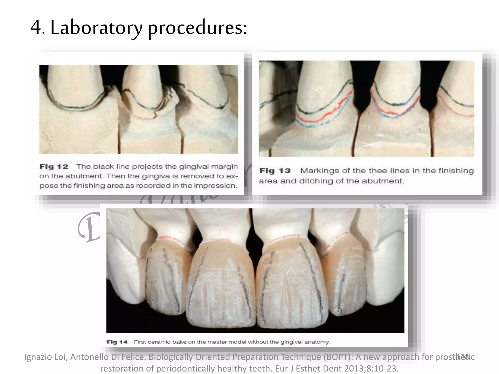 4. Laboratory procedures:
128
Ignazio Loi, Antonello Di Felice. Biologically Oriented Preparation Technique (BOPT): A new approach for prosthetic
restoration of periodontically healthy teeth. Eur J Esthet Dent 2013;8:10-23.
 