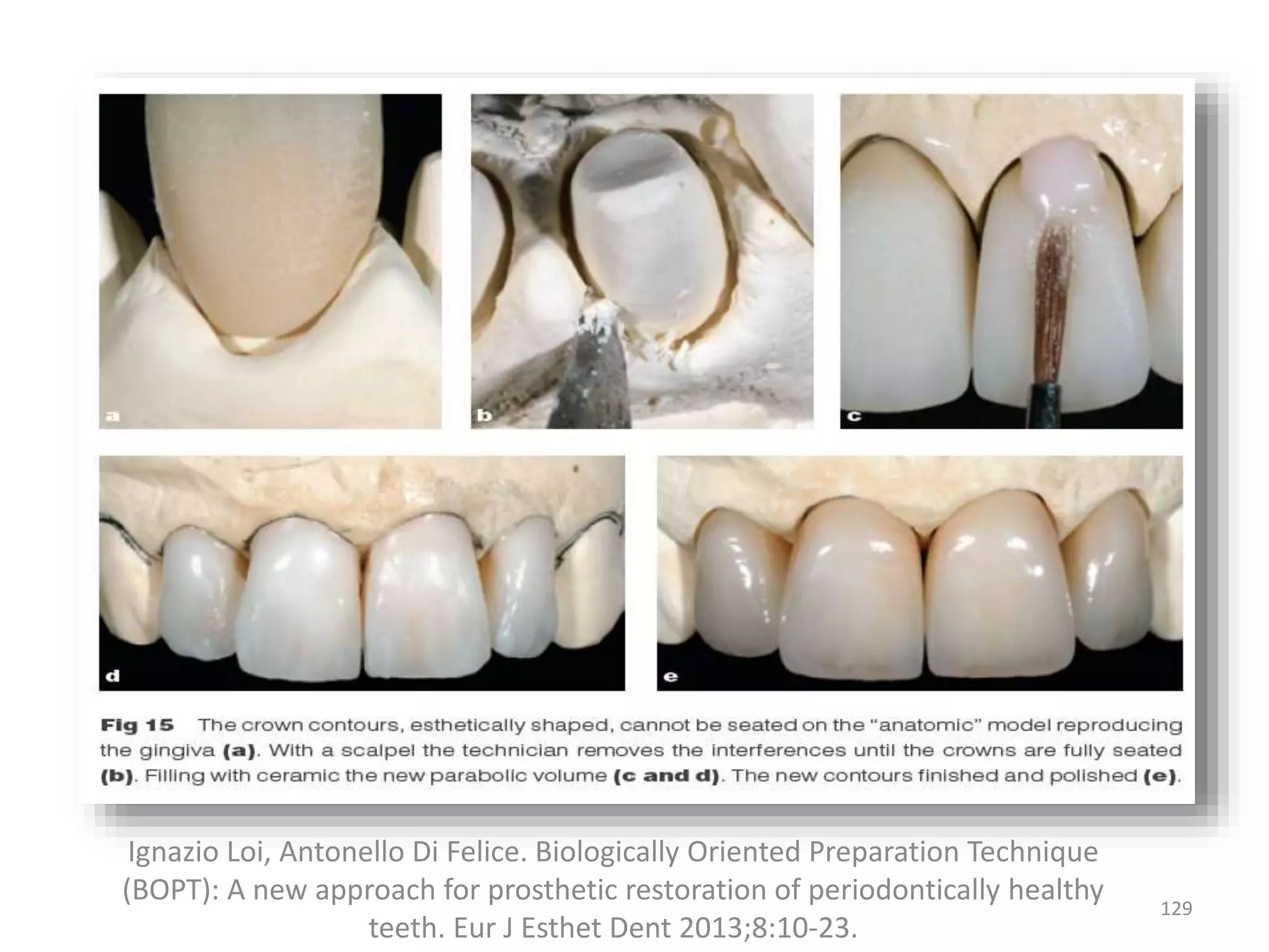 129
Ignazio Loi, Antonello Di Felice. Biologically Oriented Preparation Technique
(BOPT): A new approach for prosthetic restoration of periodontically healthy
teeth. Eur J Esthet Dent 2013;8:10-23.
 