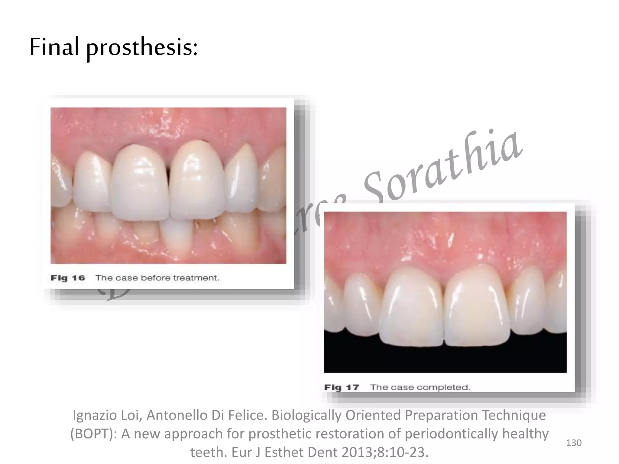 Final prosthesis:
130
Ignazio Loi, Antonello Di Felice. Biologically Oriented Preparation Technique
(BOPT): A new approach for prosthetic restoration of periodontically healthy
teeth. Eur J Esthet Dent 2013;8:10-23.
 