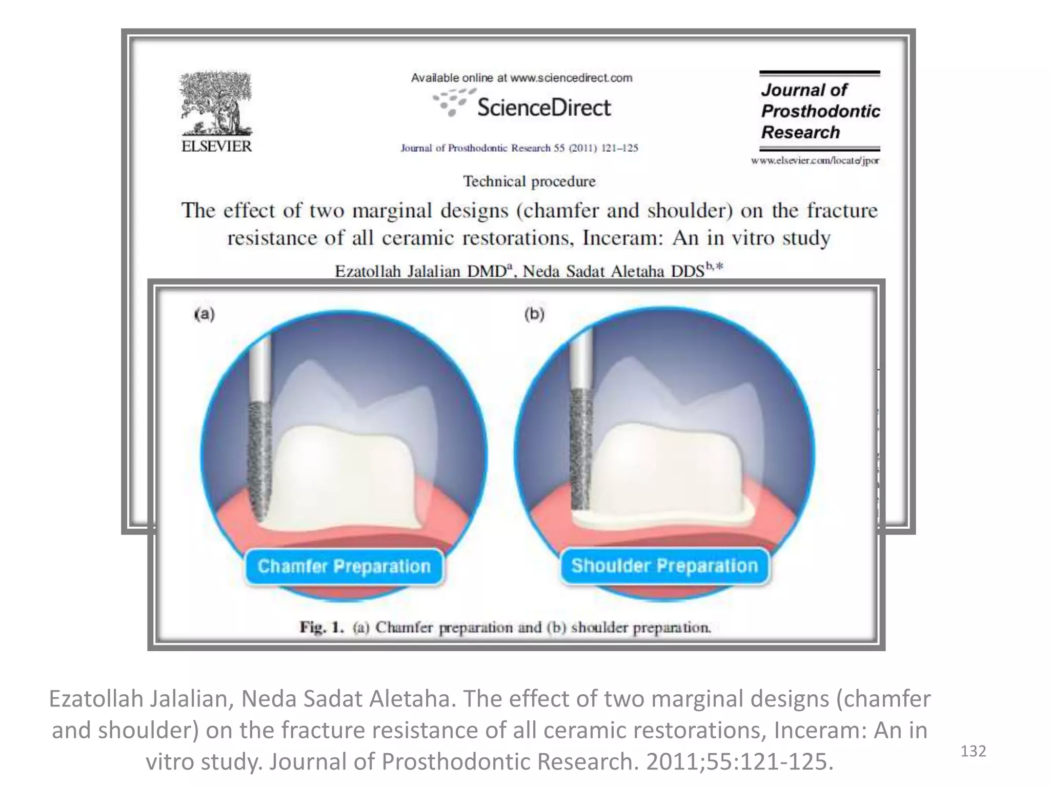 Ezatollah Jalalian, Neda Sadat Aletaha. The effect of two marginal designs (chamfer
and shoulder) on the fracture resistance of all ceramic restorations, Inceram: An in
vitro study. Journal of Prosthodontic Research. 2011;55:121-125.
132
 