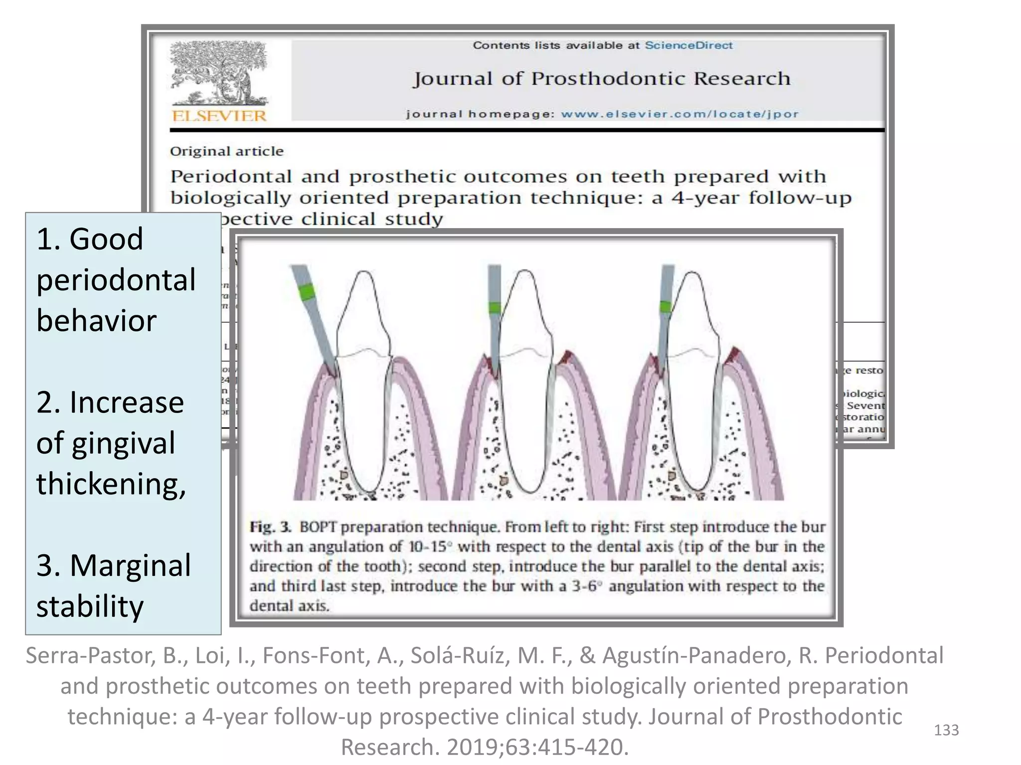Serra-Pastor, B., Loi, I., Fons-Font, A., Solá-Ruíz, M. F., & Agustín-Panadero, R. Periodontal
and prosthetic outcomes on teeth prepared with biologically oriented preparation
technique: a 4-year follow-up prospective clinical study. Journal of Prosthodontic
Research. 2019;63:415-420.
133
1. Good
periodontal
behavior
2. Increase
of gingival
thickening,
3. Marginal
stability
 