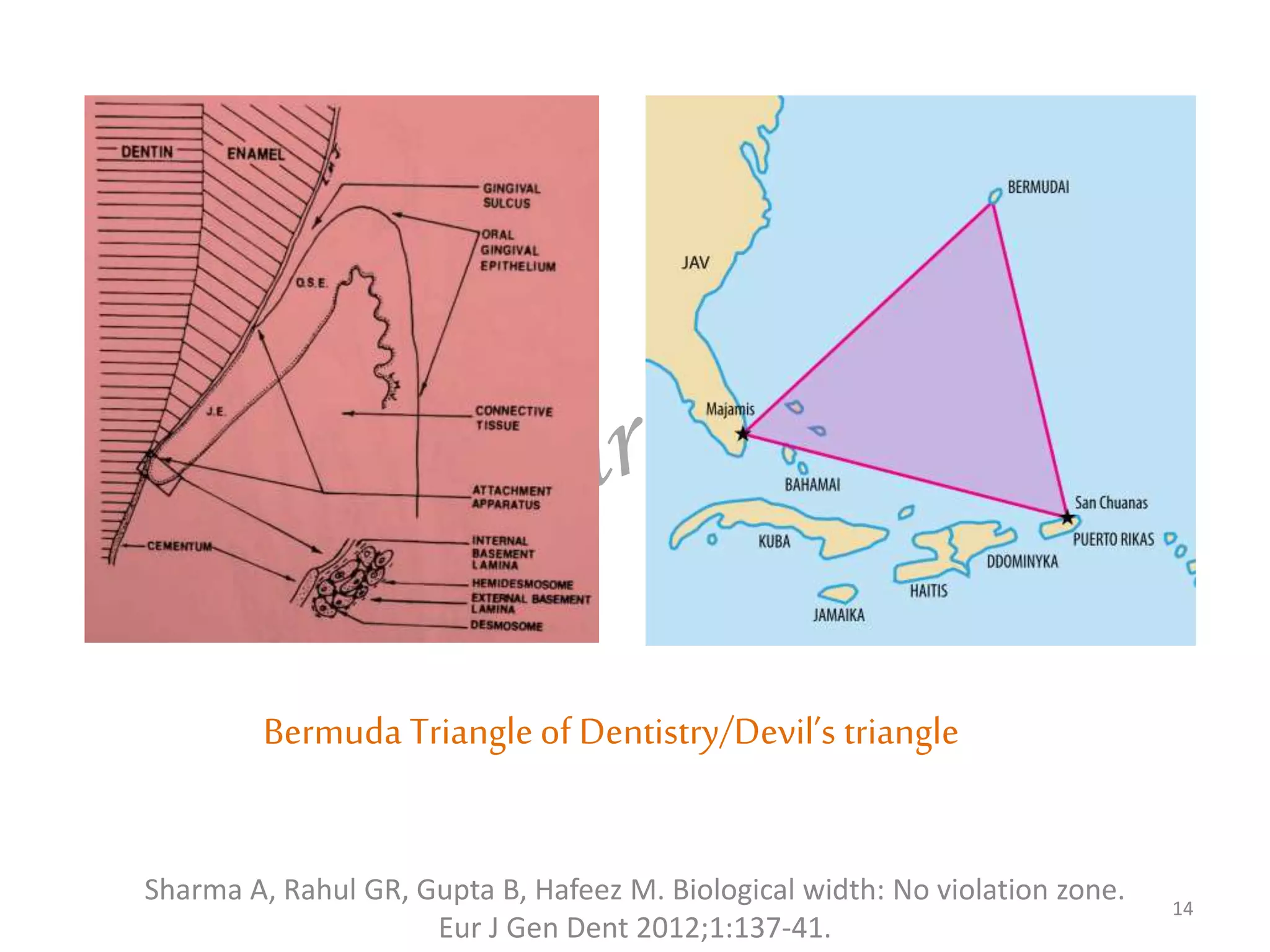 Sharma A, Rahul GR, Gupta B, Hafeez M. Biological width: No violation zone.
Eur J Gen Dent 2012;1:137-41.
14
Bermuda Triangleof Dentistry/Devil’s triangle
 