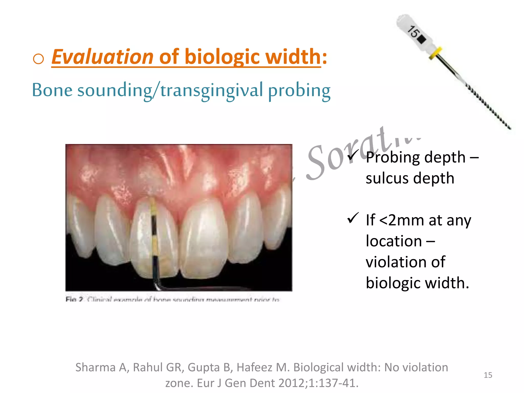 o Evaluation of biologic width:
Bone sounding/transgingival probing
15
 Probing depth –
sulcus depth
 If <2mm at any
location –
violation of
biologic width.
Sharma A, Rahul GR, Gupta B, Hafeez M. Biological width: No violation
zone. Eur J Gen Dent 2012;1:137-41.
 