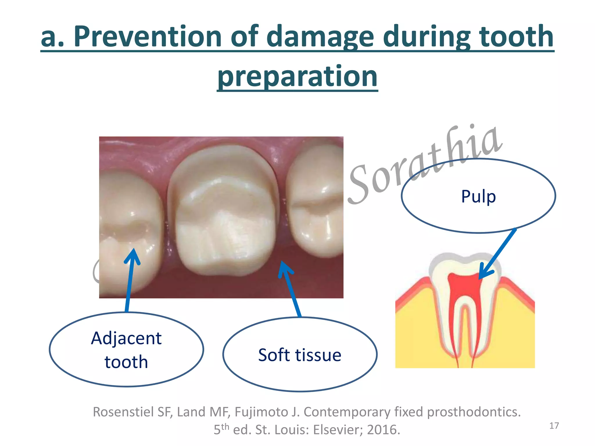 a. Prevention of damage during tooth
preparation
Rosenstiel SF, Land MF, Fujimoto J. Contemporary fixed prosthodontics.
5th ed. St. Louis: Elsevier; 2016. 17
Soft tissue
Adjacent
tooth
Pulp
 
