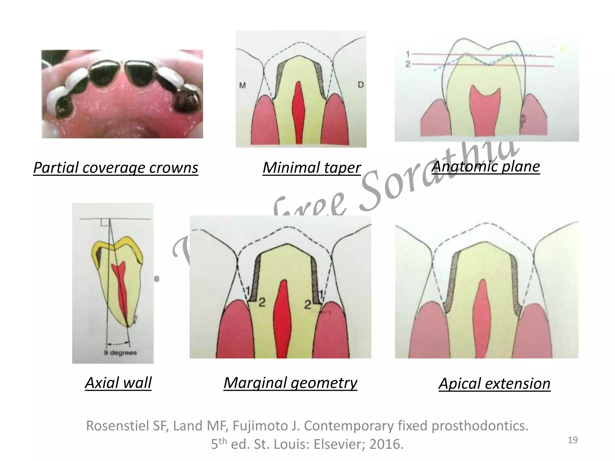 19
Rosenstiel SF, Land MF, Fujimoto J. Contemporary fixed prosthodontics.
5th ed. St. Louis: Elsevier; 2016.
Partial coverage crowns Minimal taper Anatomic plane
Axial wall Marginal geometry Apical extension
 