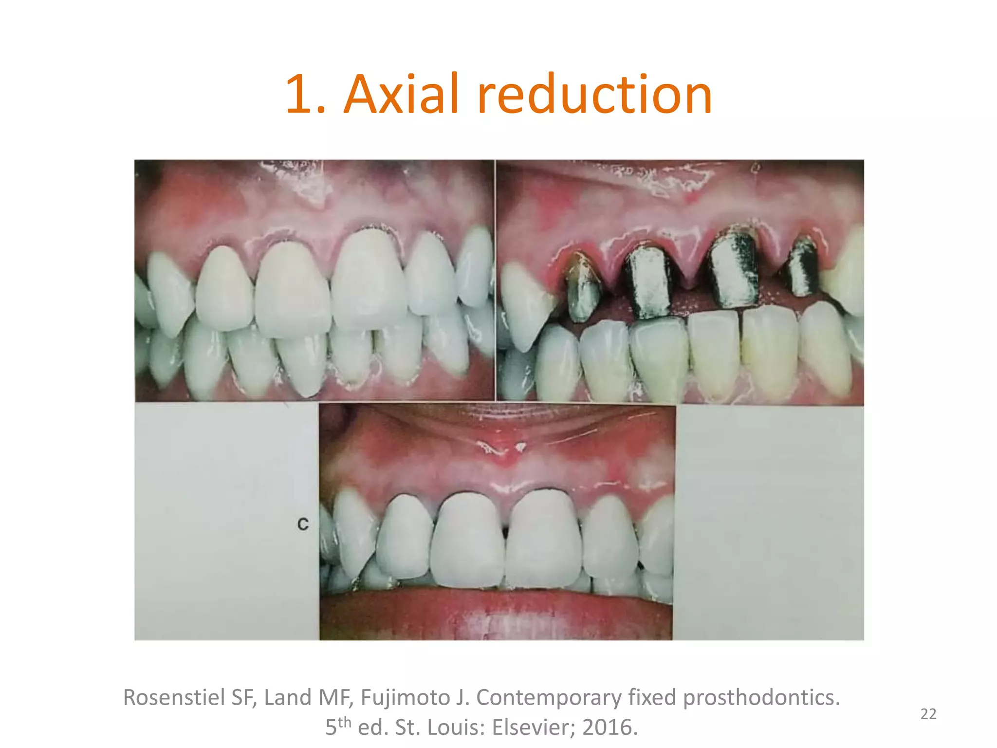 1. Axial reduction
22
Rosenstiel SF, Land MF, Fujimoto J. Contemporary fixed prosthodontics.
5th ed. St. Louis: Elsevier; 2016.
 