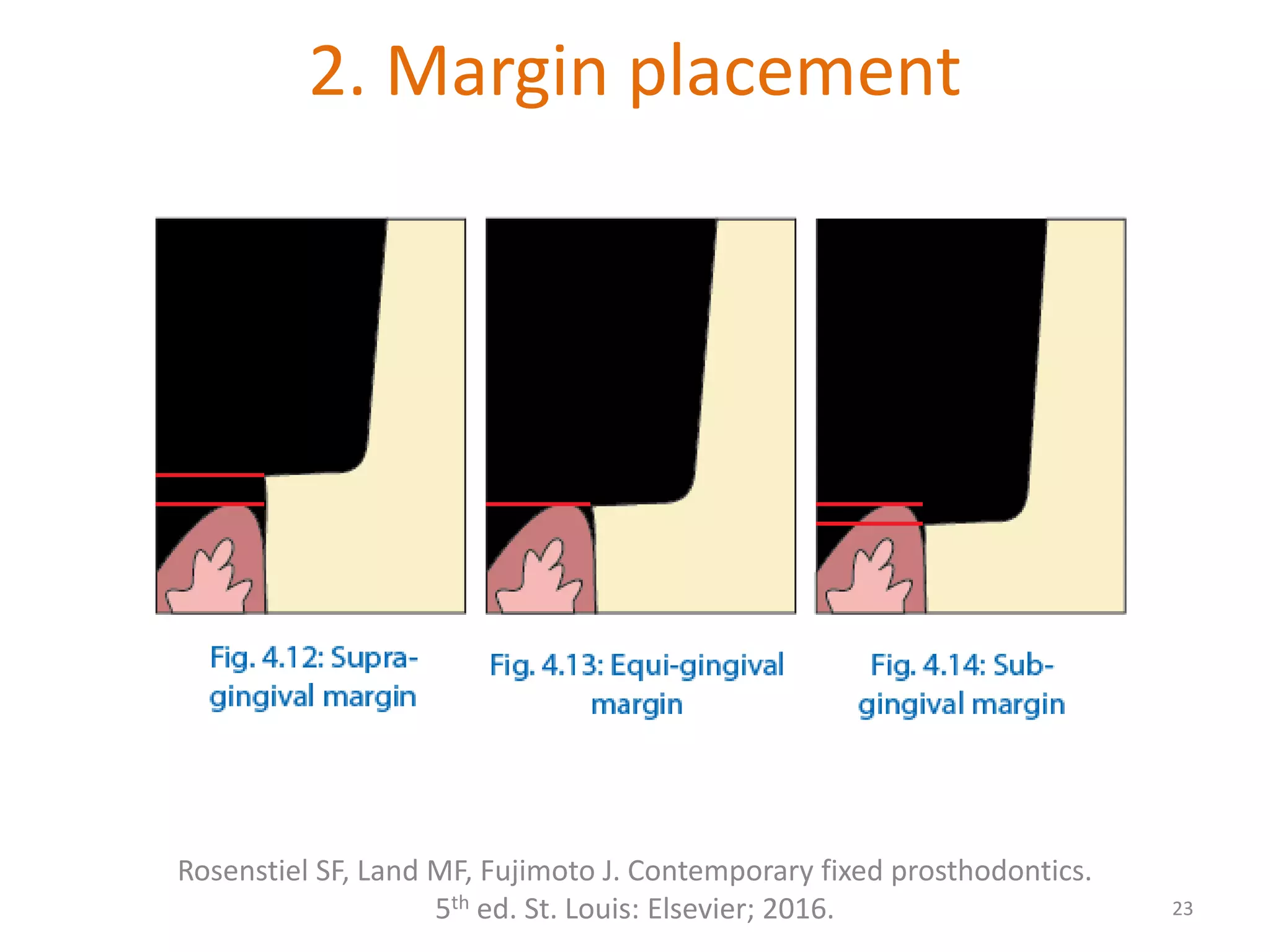 2. Margin placement
23
Rosenstiel SF, Land MF, Fujimoto J. Contemporary fixed prosthodontics.
5th ed. St. Louis: Elsevier; 2016.
 
